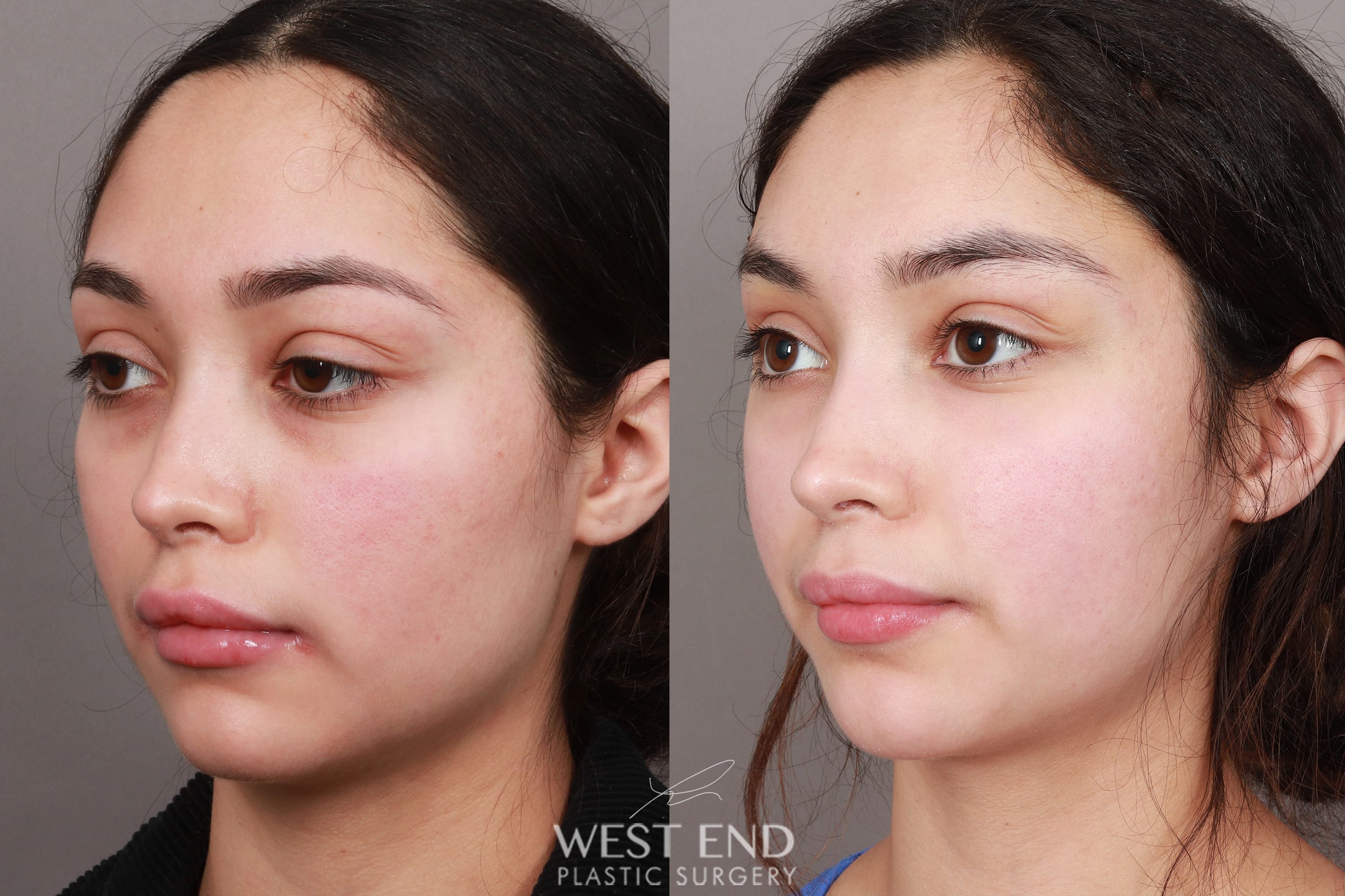 Temporal Brow Lift (1 Week Post-op) before photo. Individual results may vary.