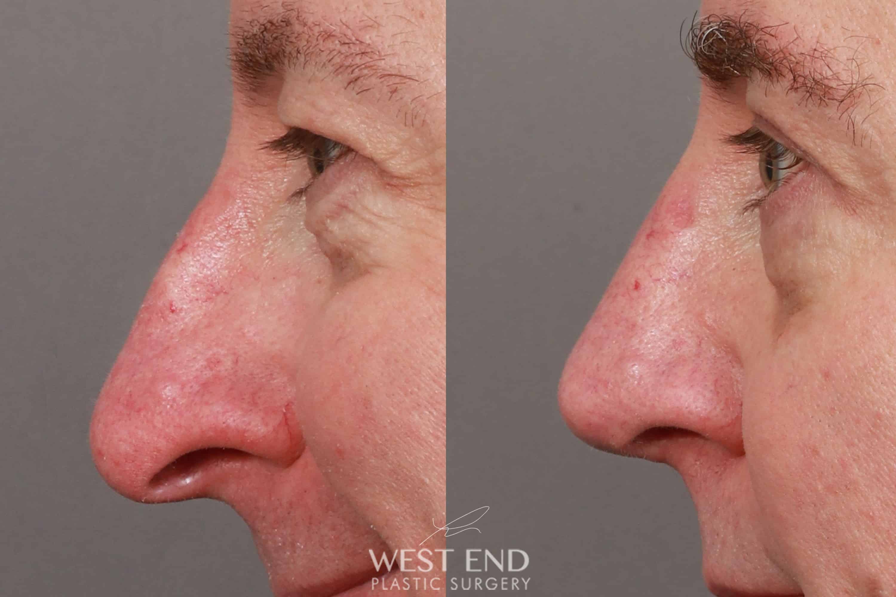 Open Septorhinoplasty with ClariFix (3 Months Post-Op) before photo. Individual results may vary.