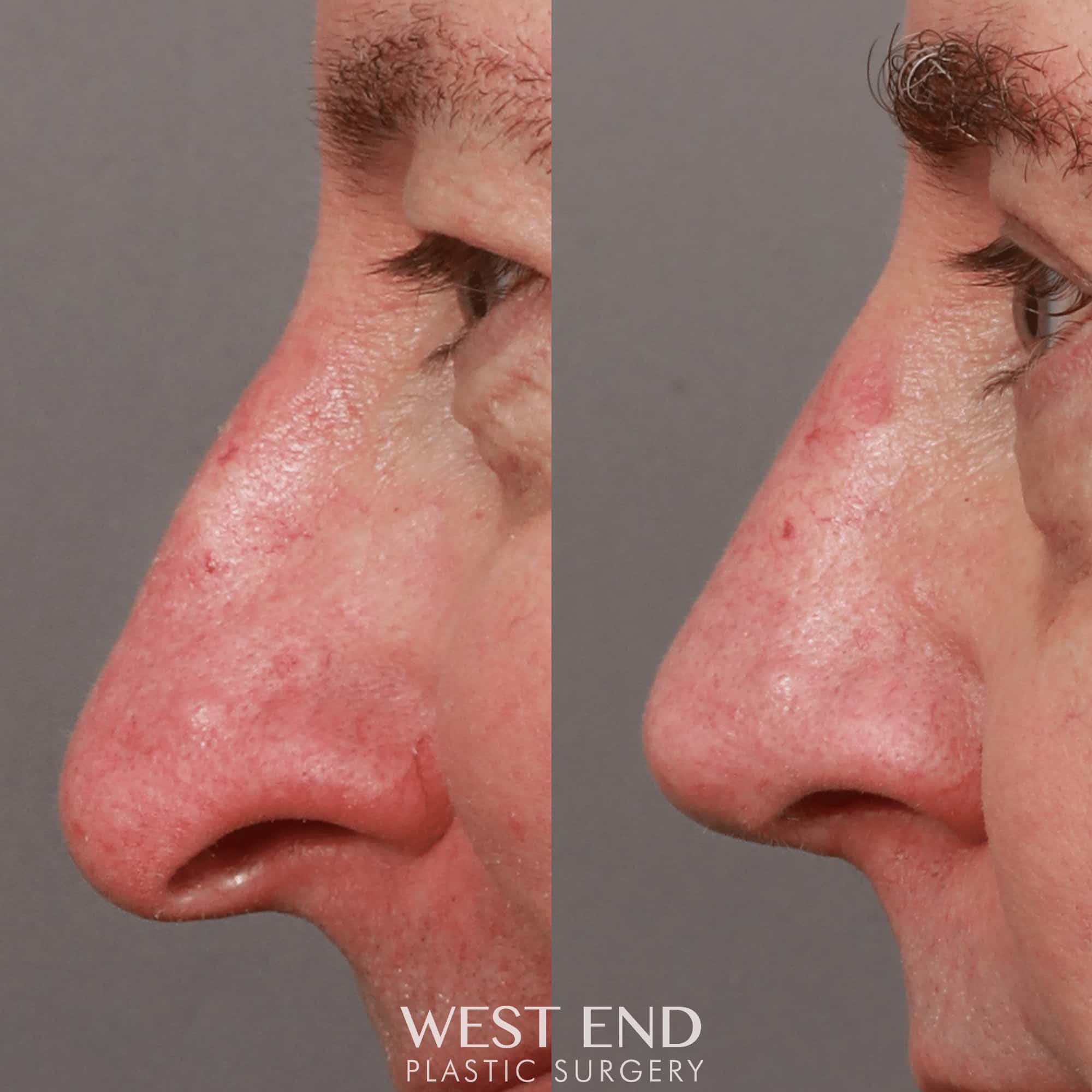 Open Septorhinoplasty with ClariFix (3 Months Post-Op) before photo. Individual results may vary.