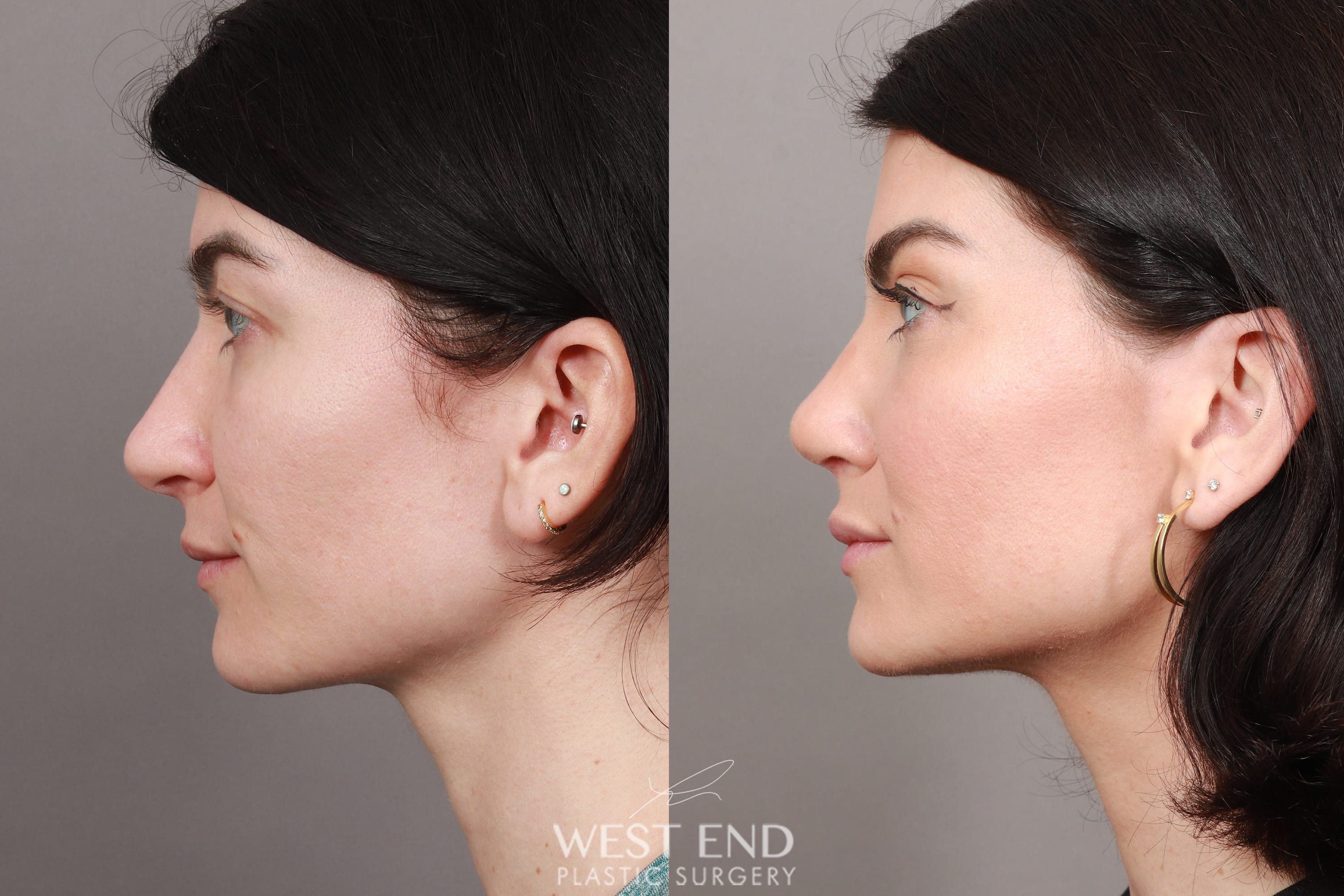 Rhinoplasty & Septoplasty (2 months post-op)