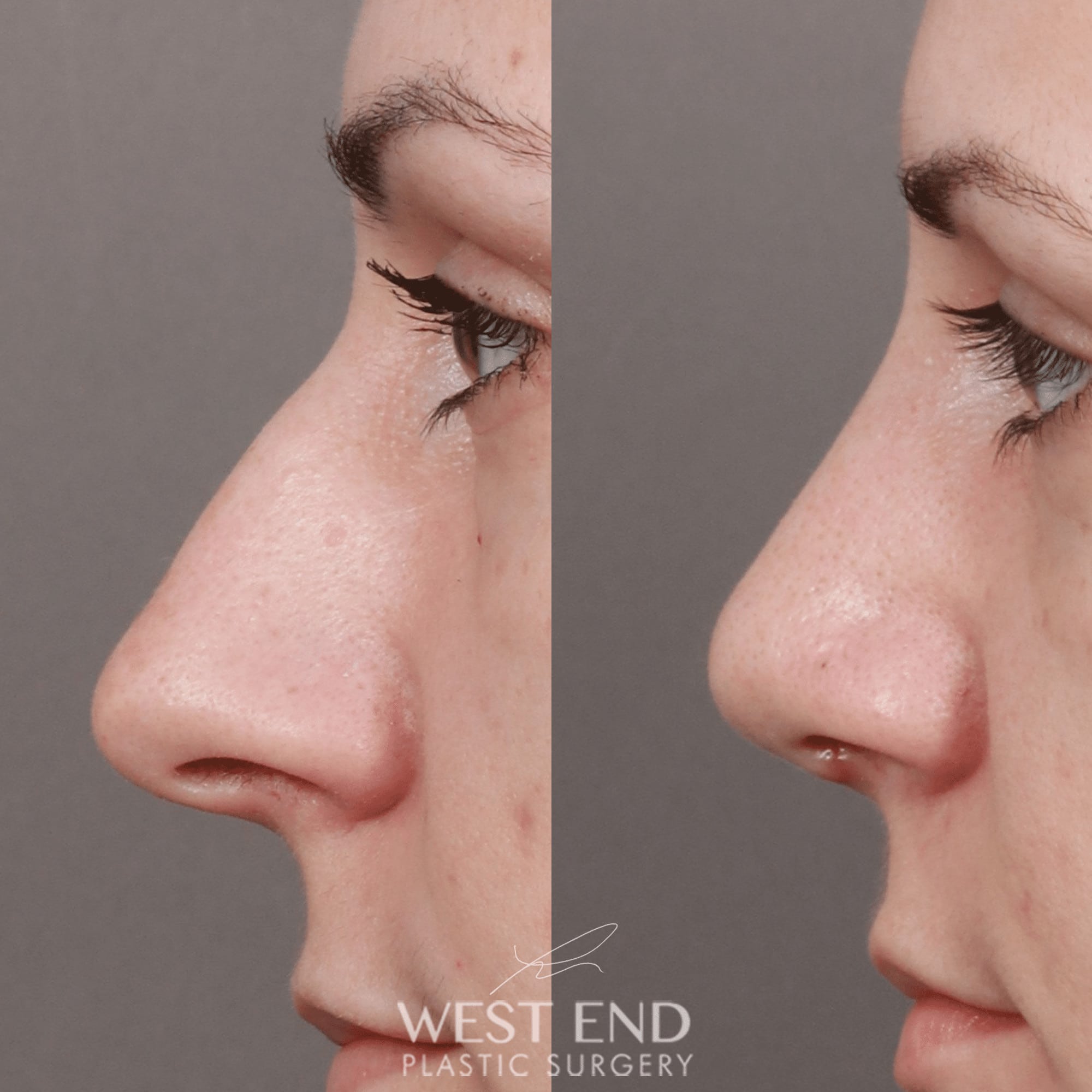 Rhinoplasty & Septoplasty (1 Month Post-op)
