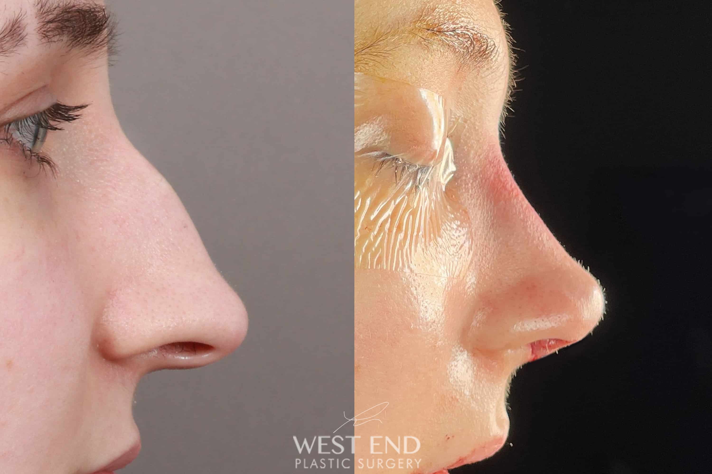 Rhinoplasty & Septoplasty (Immediately After)
