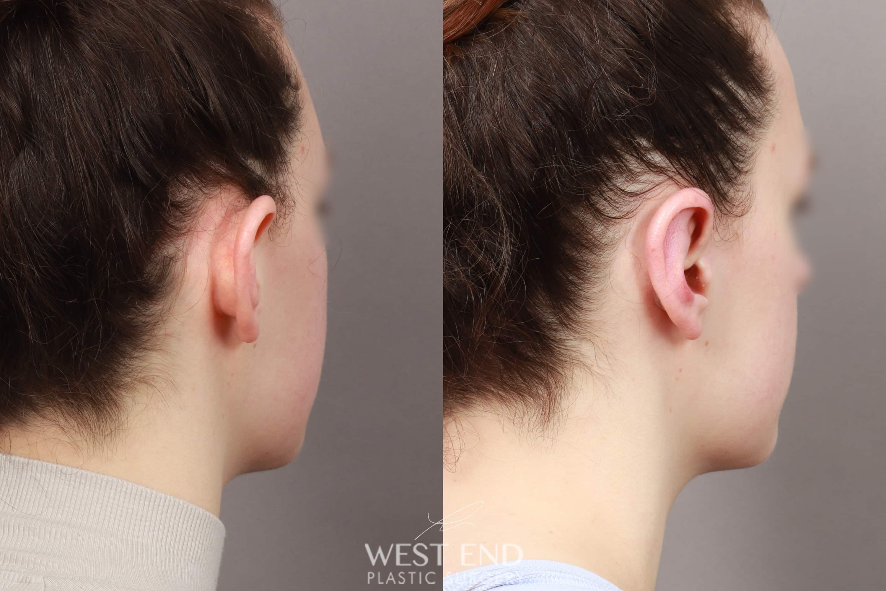 Otoplasty (2 Weeks Post-op)
