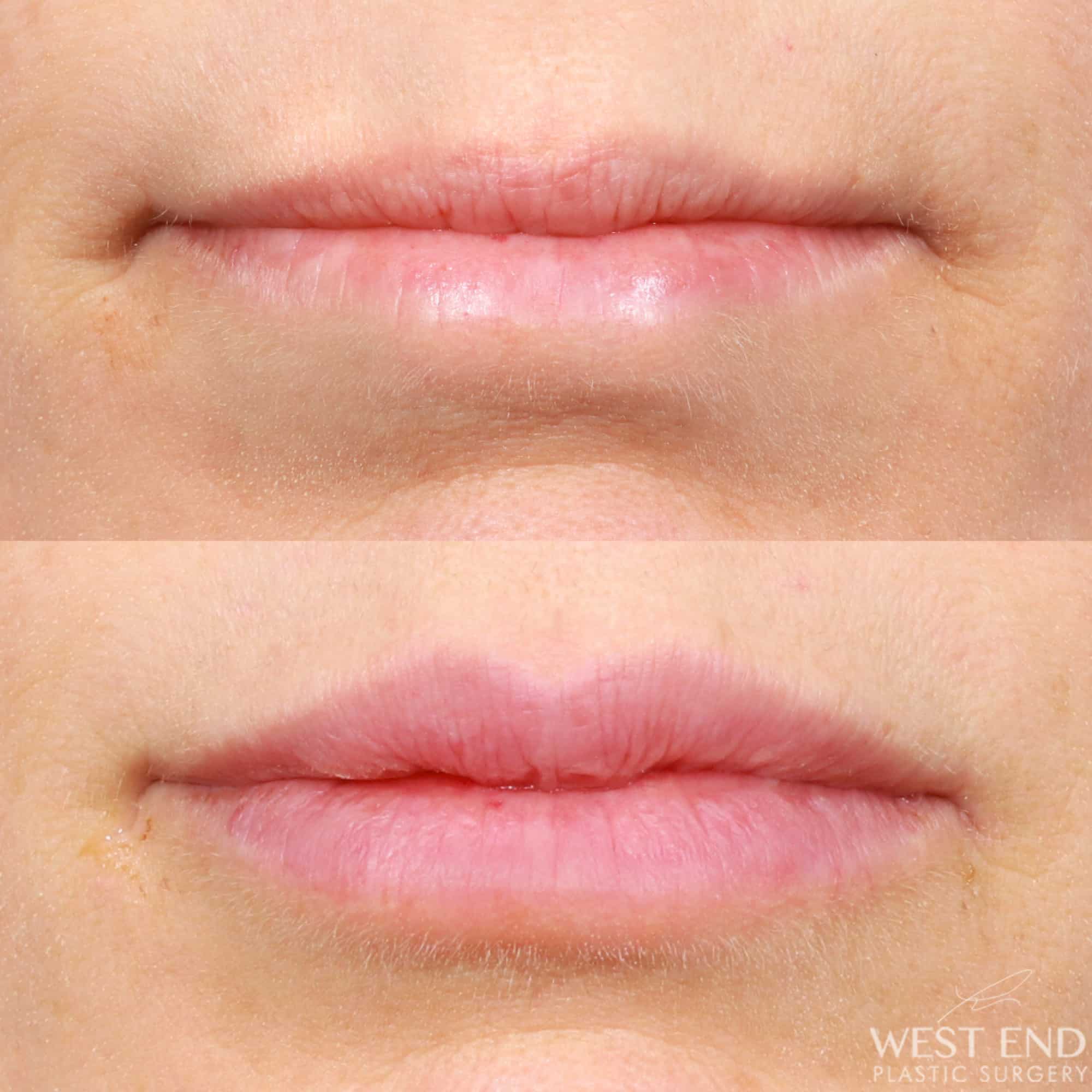 Lip Filler
