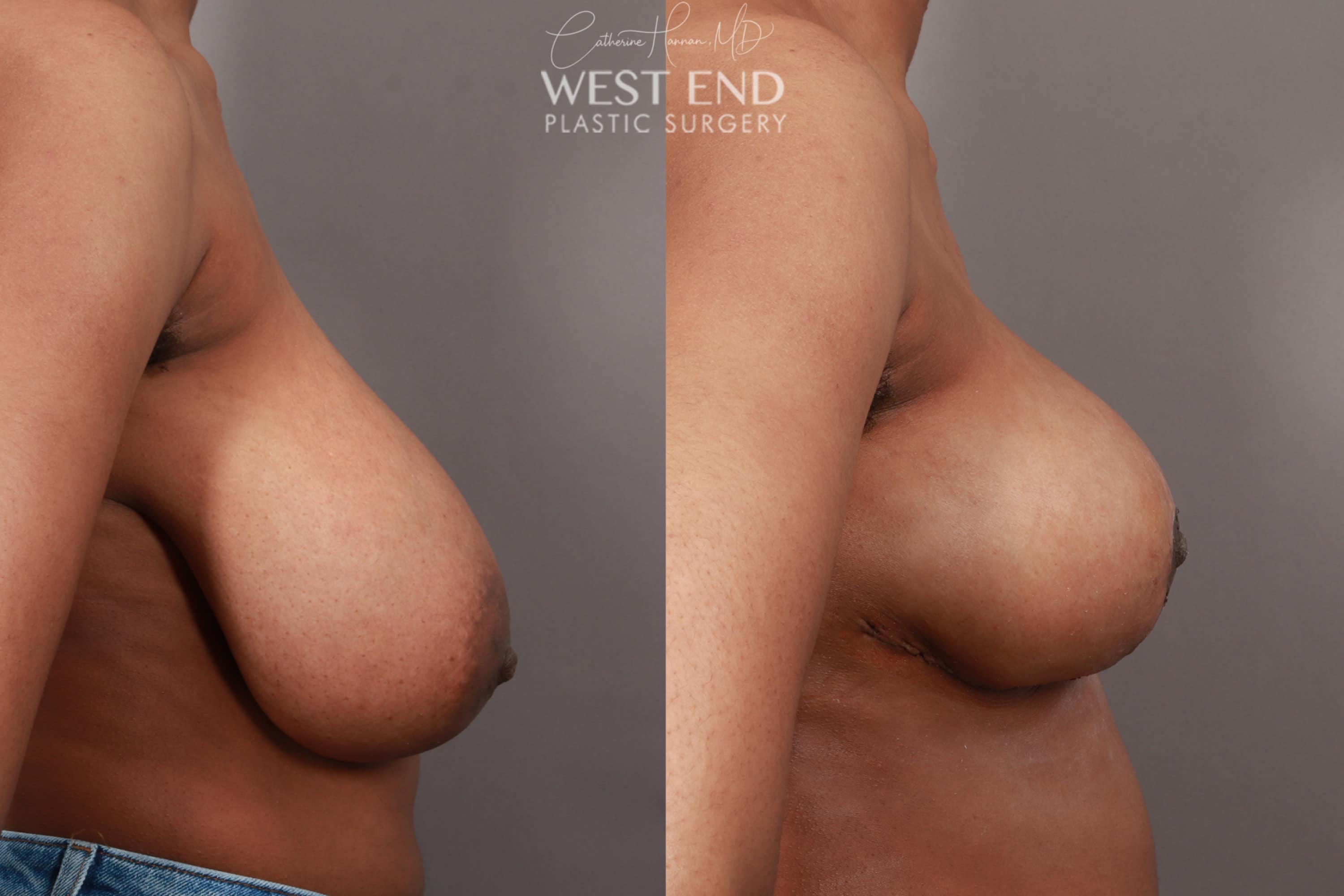 Breast Reduction (12 Days Post-op)