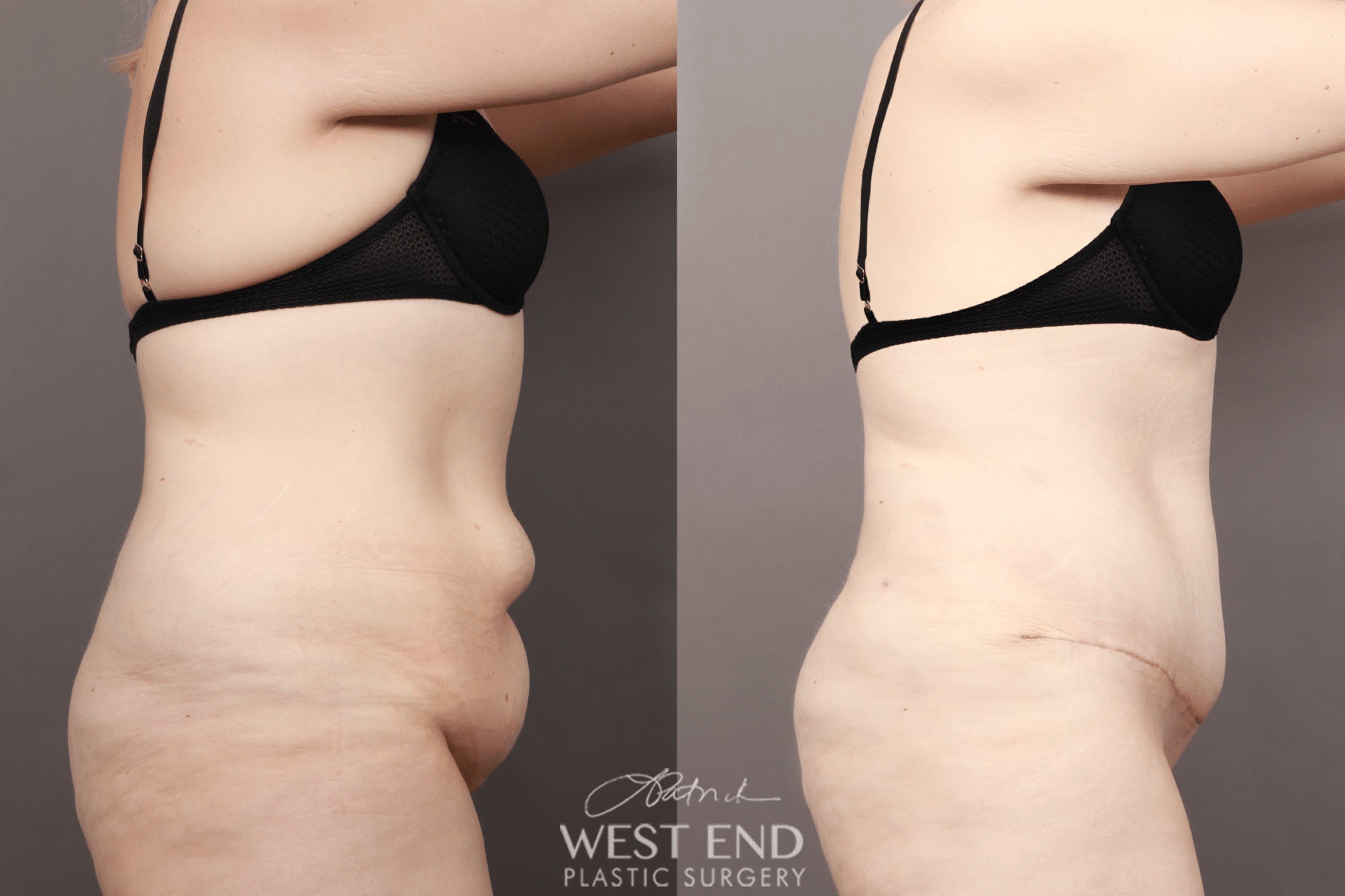 Tummy Tuck with Liposuction (1 Month Post-op)