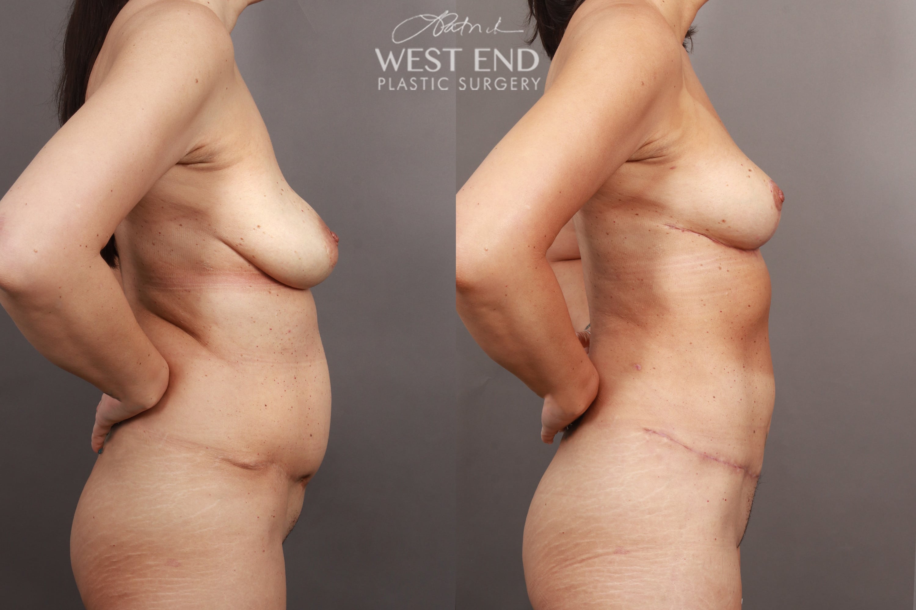 Breast Lift, Liposuction, & Scar Revision (3 Months Post-op)