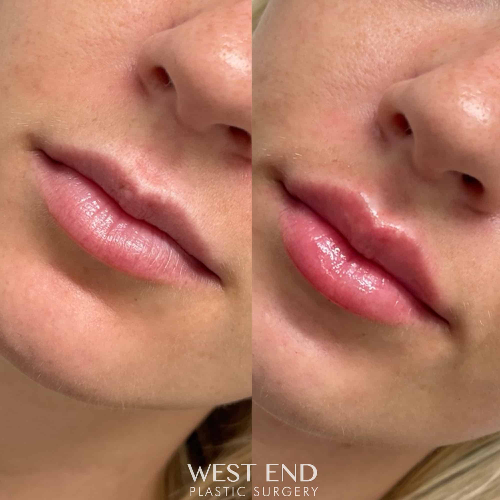Lip Filler