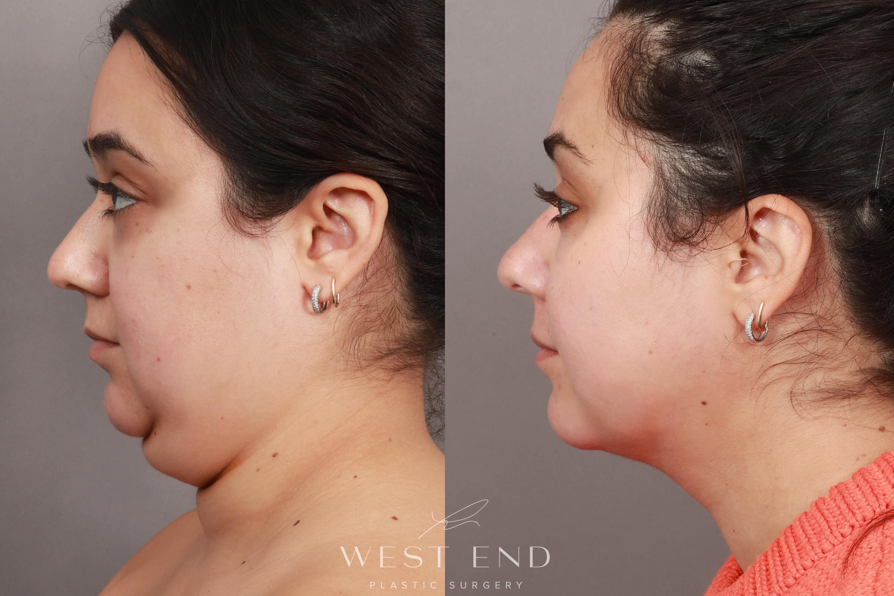 Liposuction & Renuvion Skin Tightening (2 Weeks Post-op)