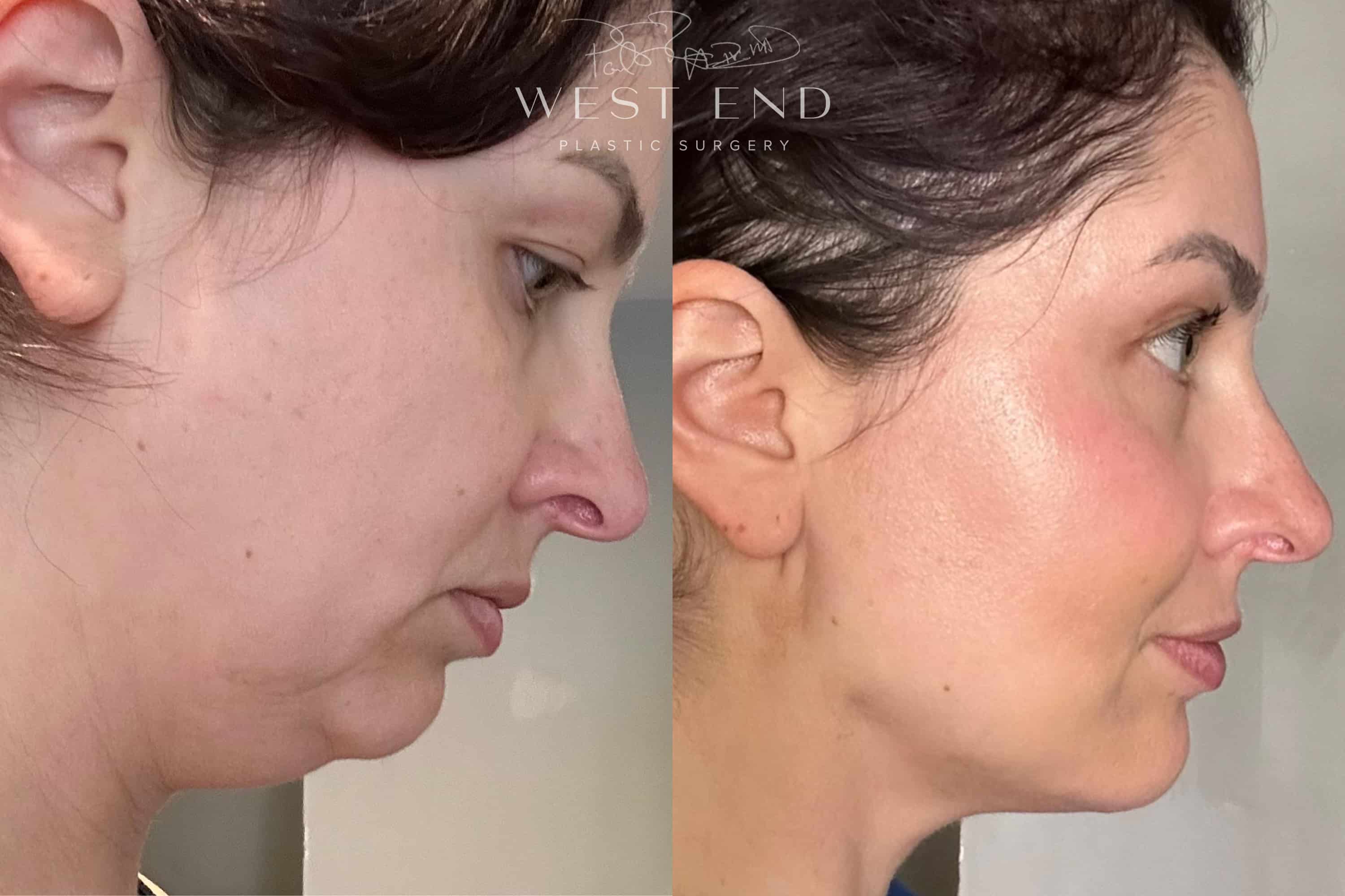 Liposuction & Renuvion Skin Tightening (9 Days Post-op)