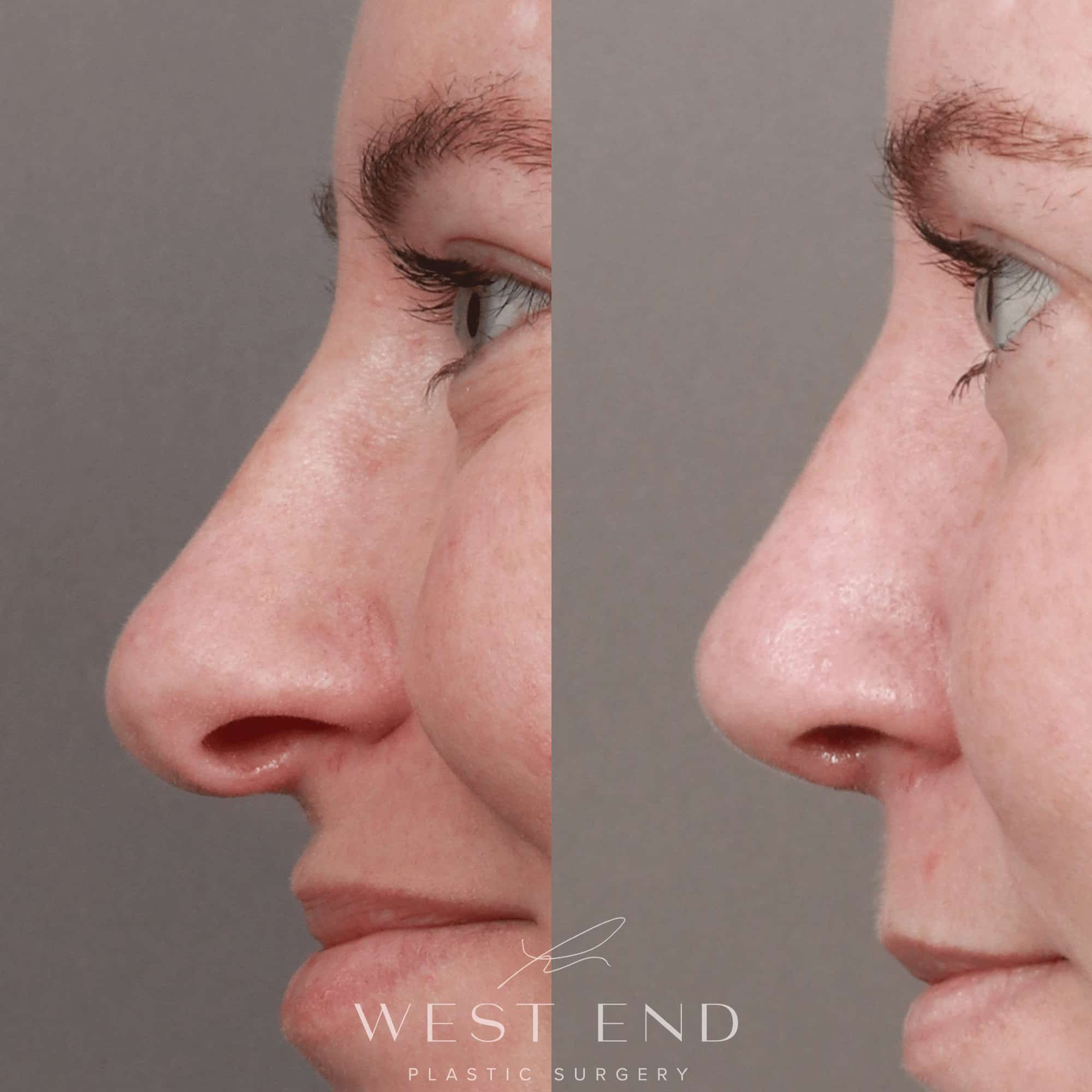 Rhinoplasty & Septoplasty with Clarifix (3 months Post-op)