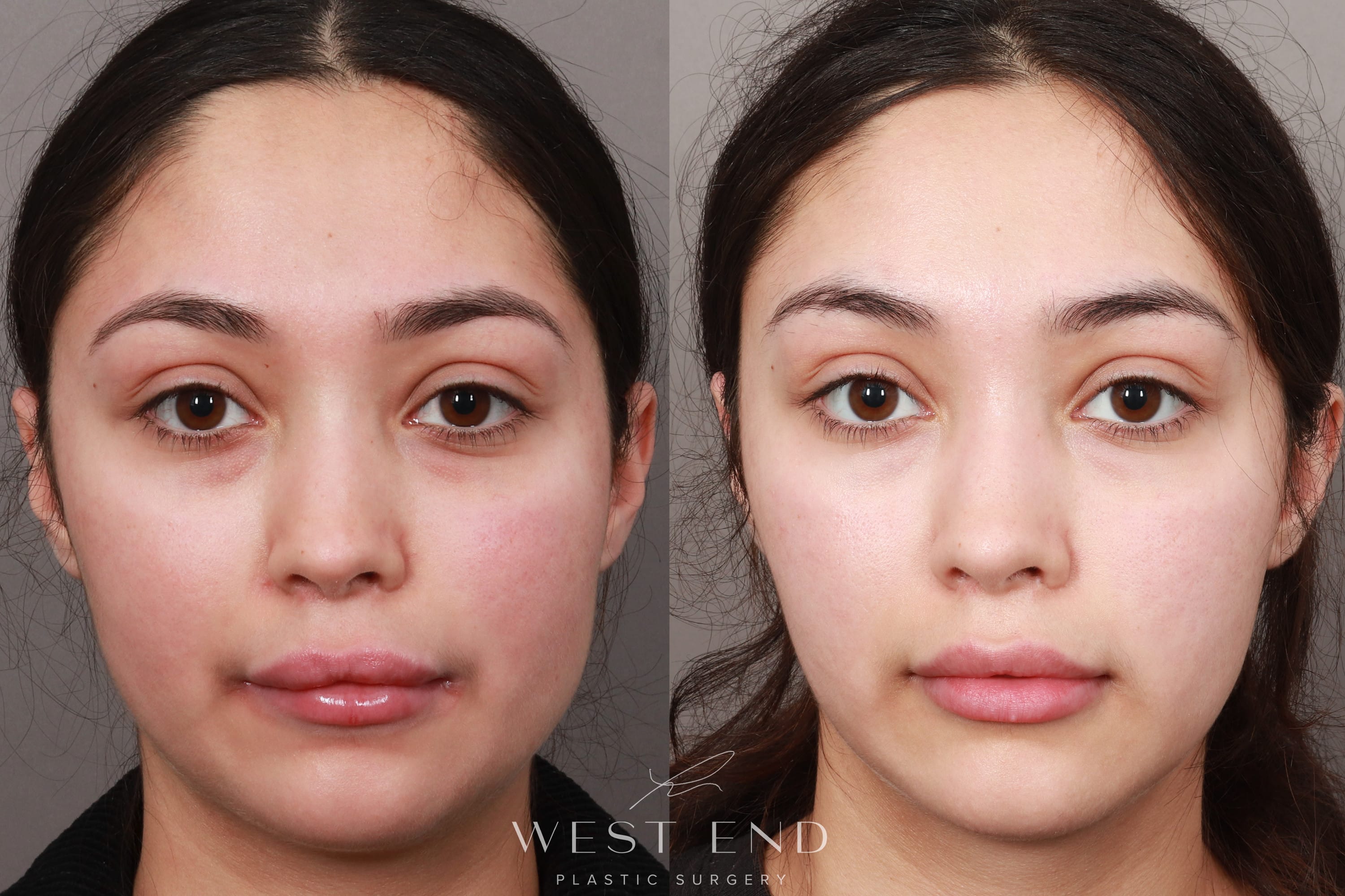Temporal Brow Lift (3 Months Post-op)