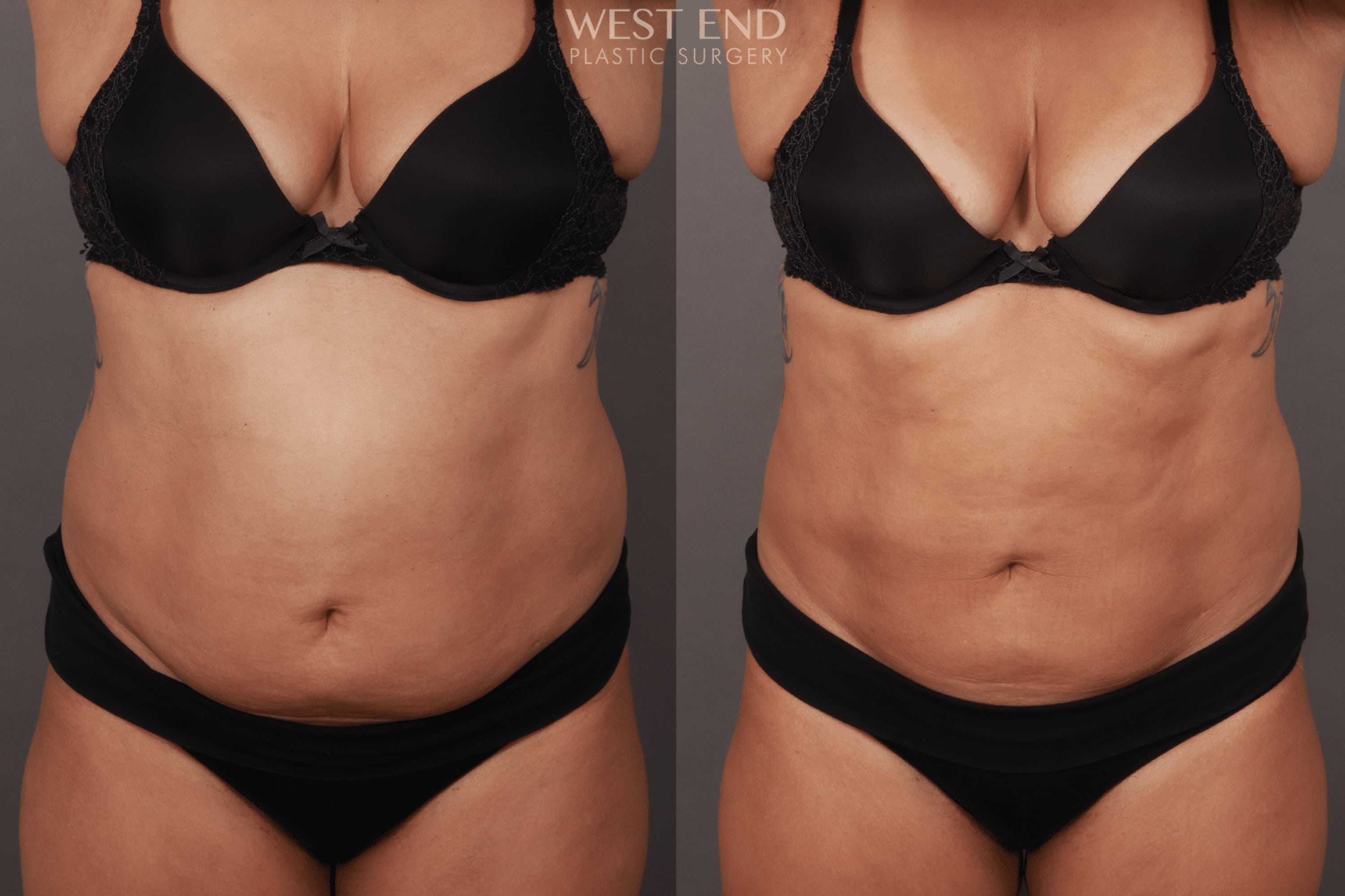 CoolSculpting
