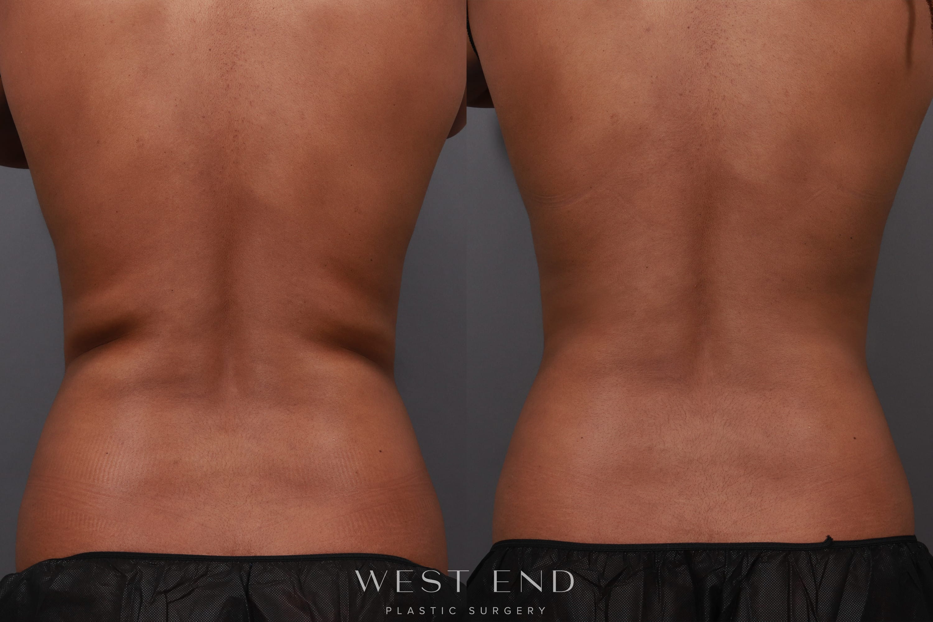 CoolSculpting