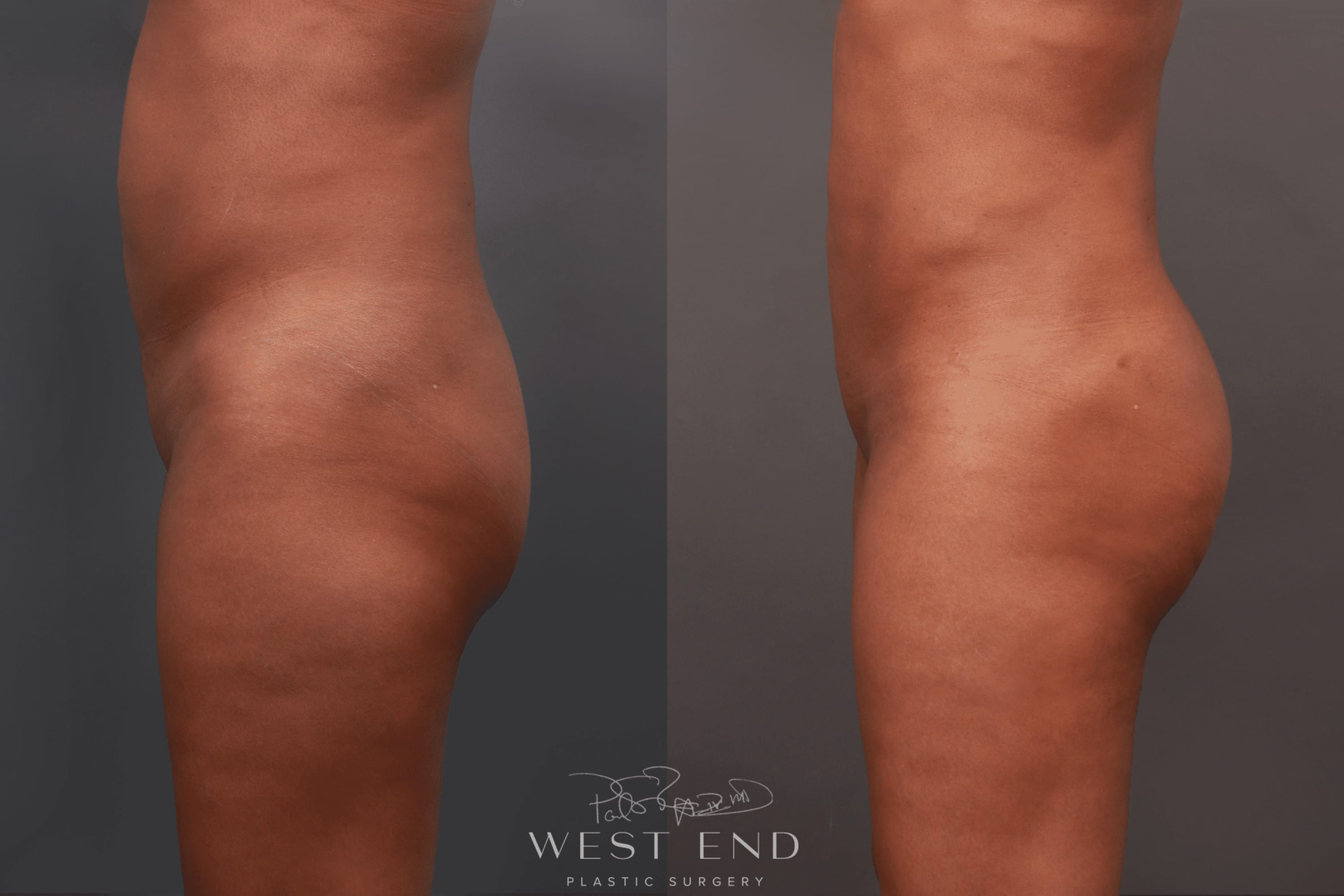 Brazilian Butt Lift & Liposuction (2 Years Post-op)