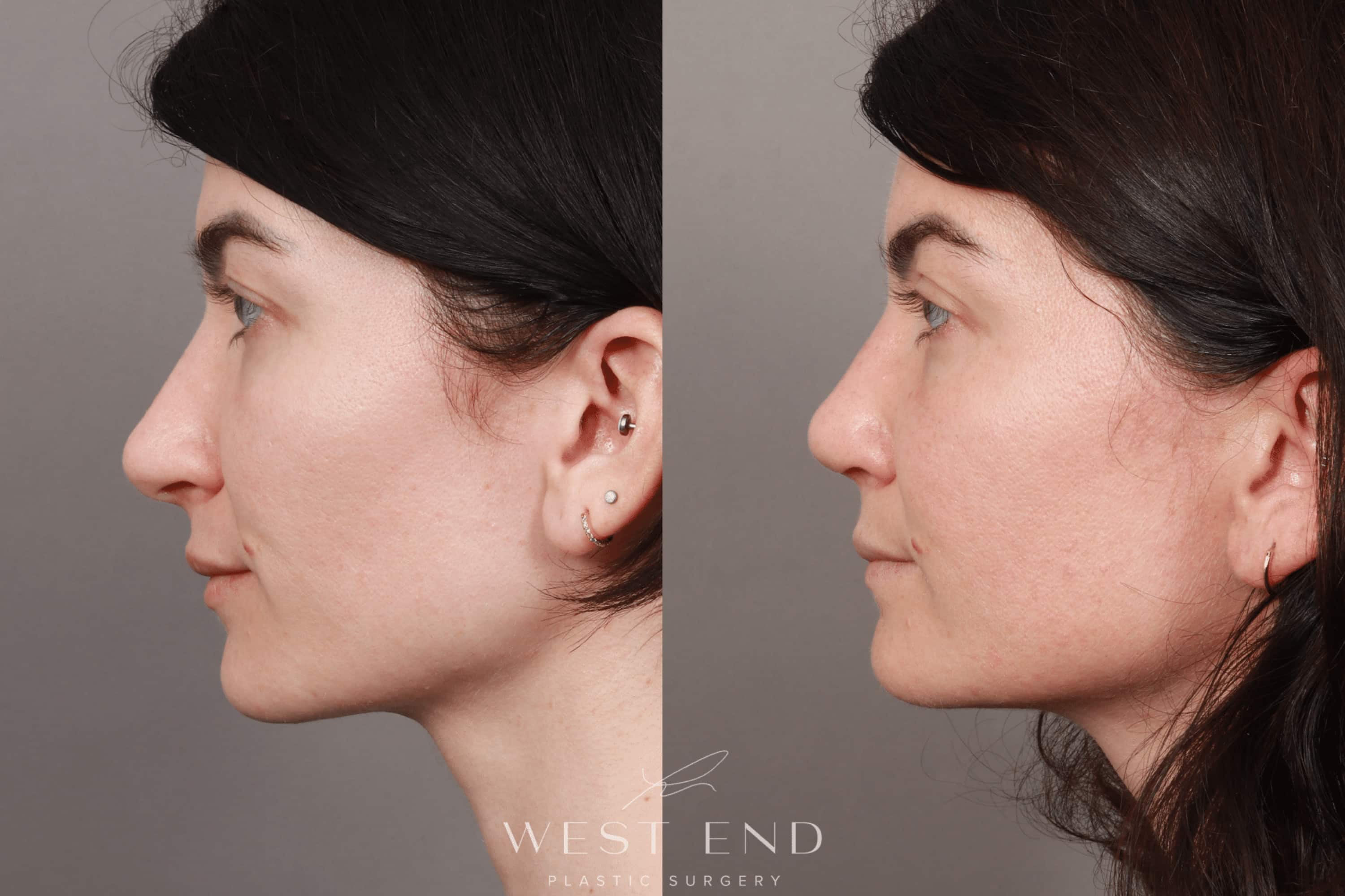 Rhinoplasty & Septoplasty (4.5 Months Post-op)