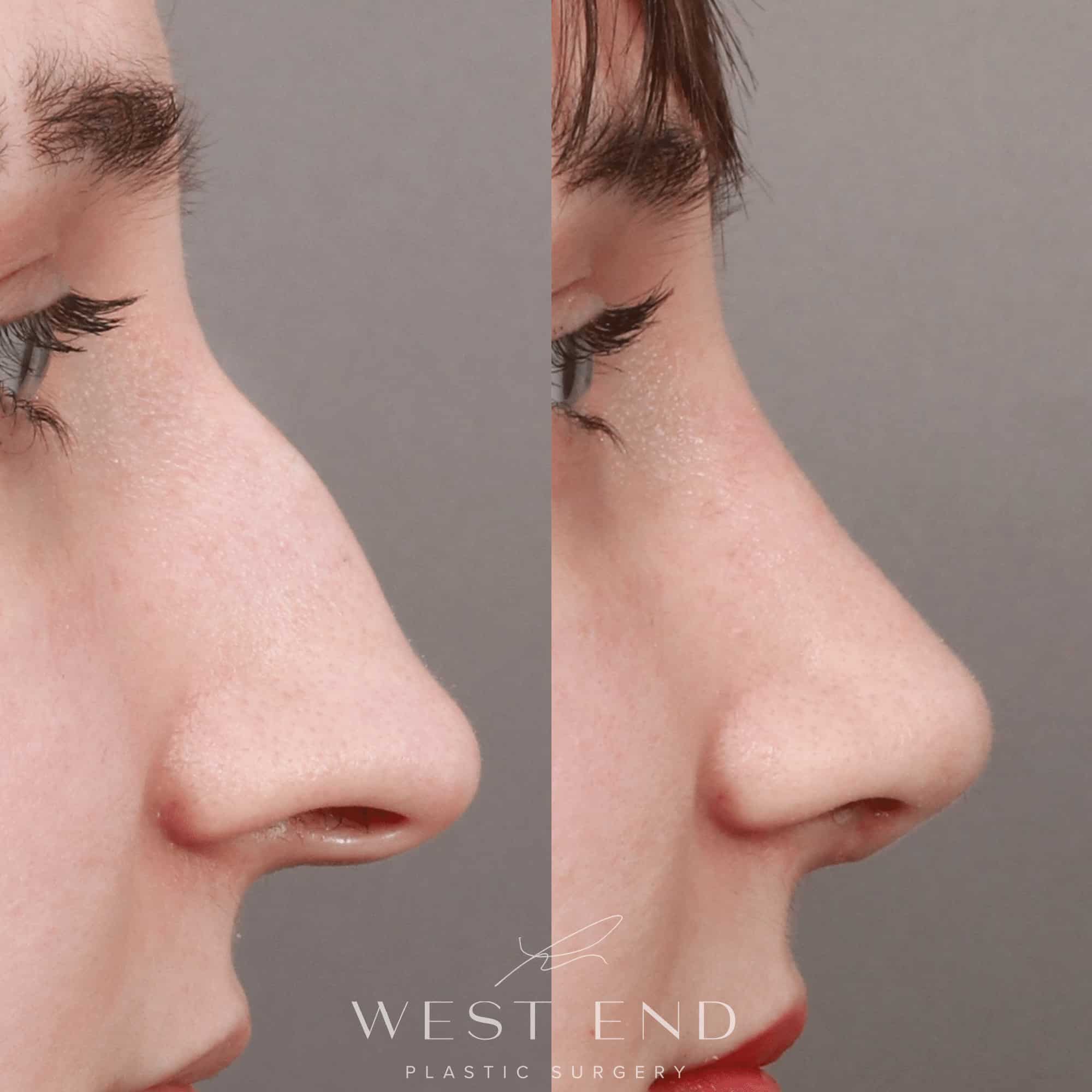 Rhinoplasty & Septoplasty (2.5 Months Post-op)