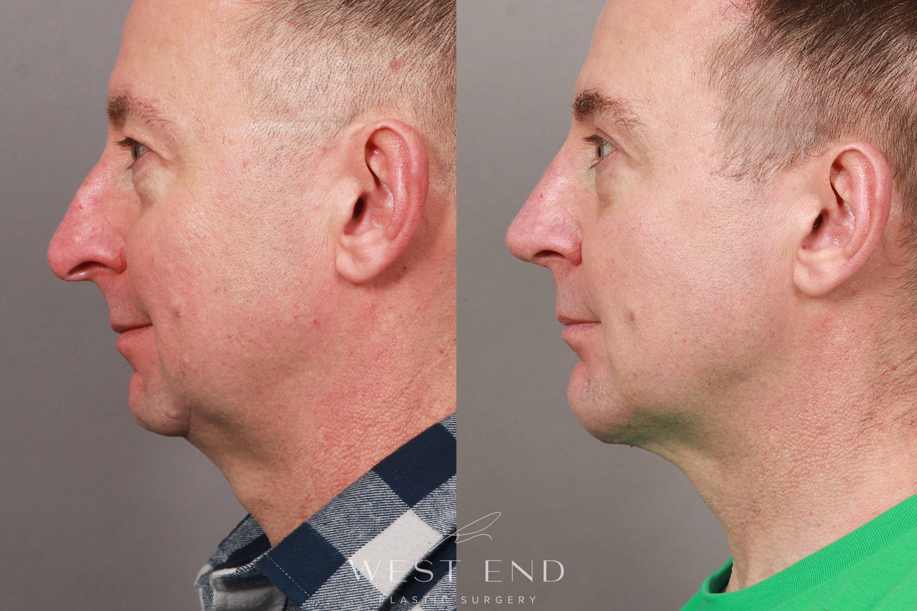 Rhinoplasty, Chin Implant, Eyelid Lift, and Brow Lift (4 Months Post-Op)