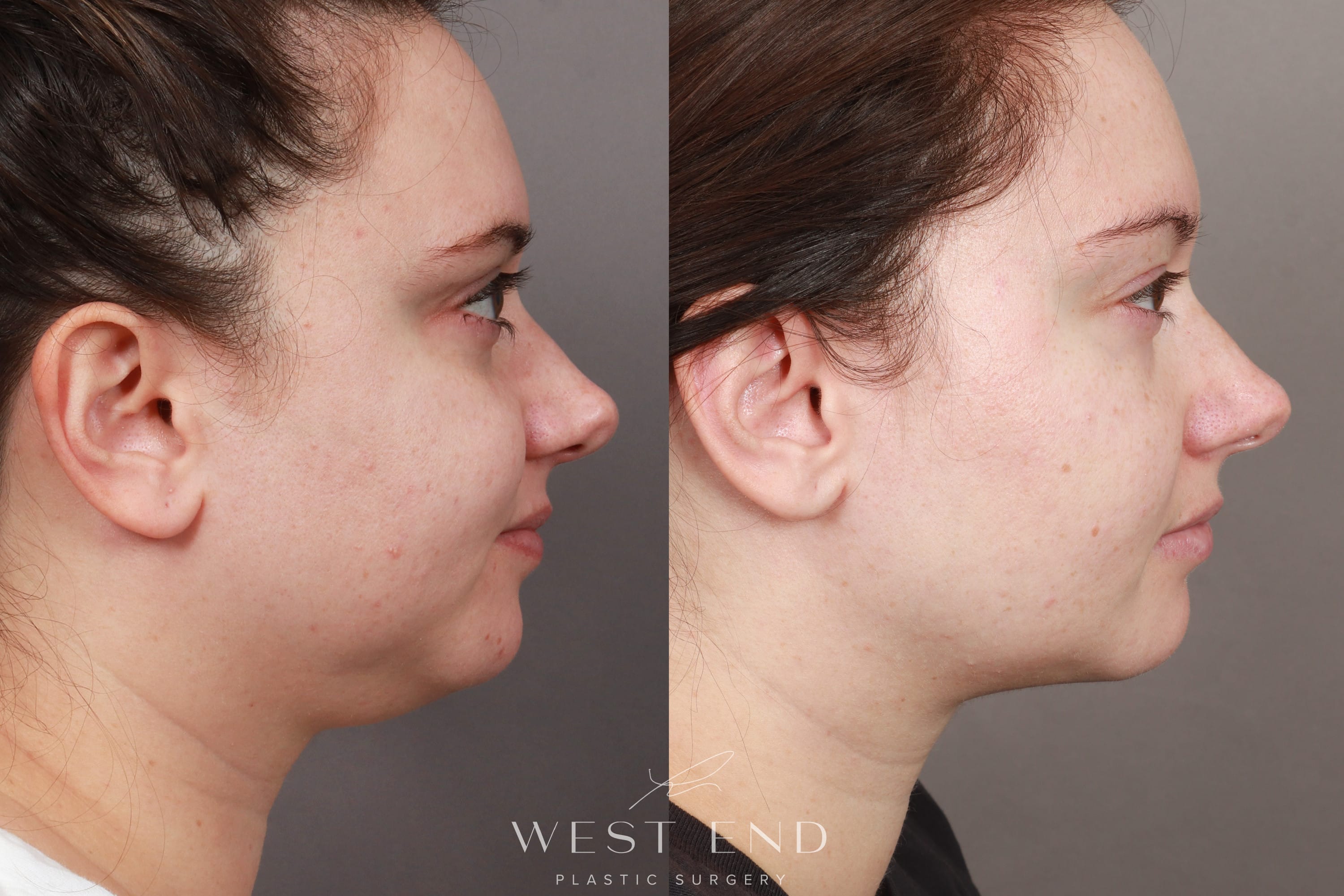 Submental Liposuction (10 Months Post-op)