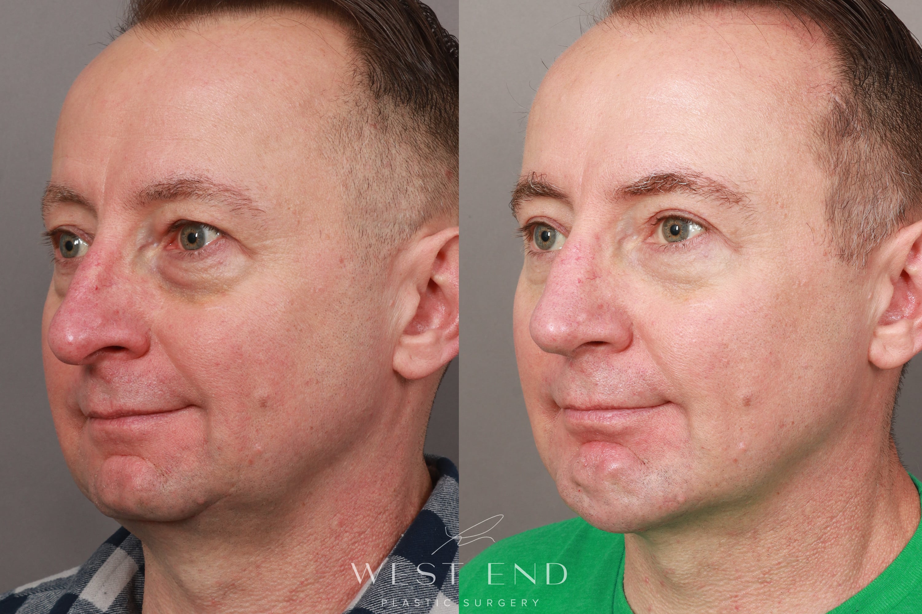 Chin Implant, Eyelid Lift, and Brow Lift (6 Months Post-Op)