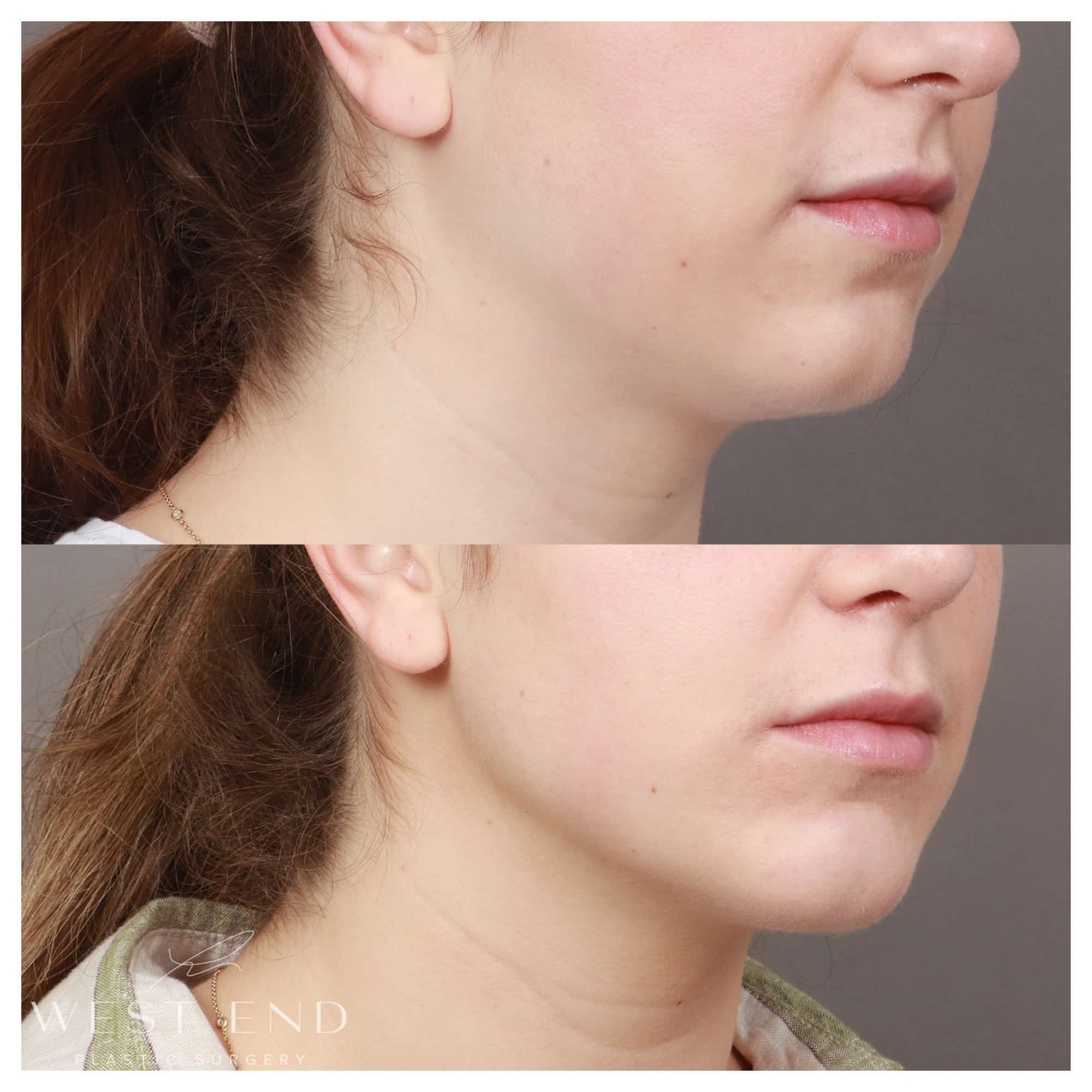 Chin Implant with Liposuction of the lower face and neck (4.5 Months Post-op)