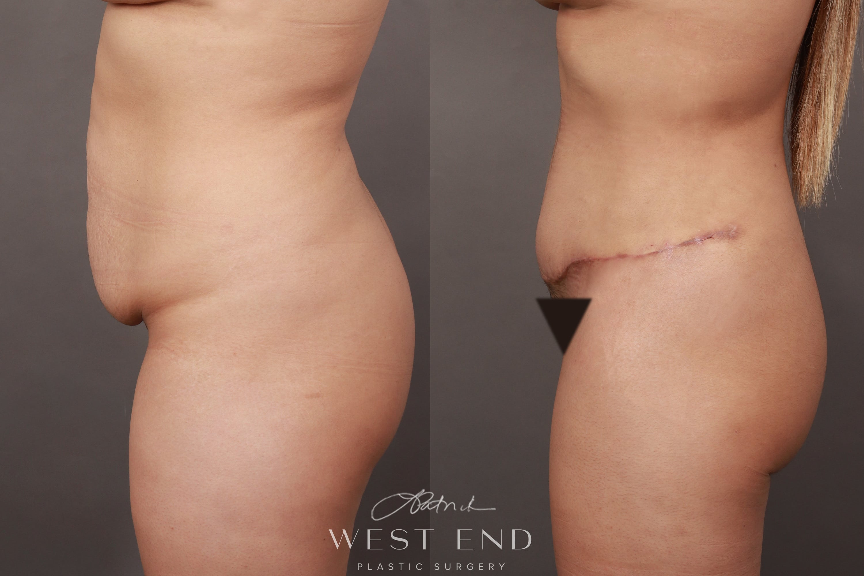 Tummy Tuck (1 Month Post-op)