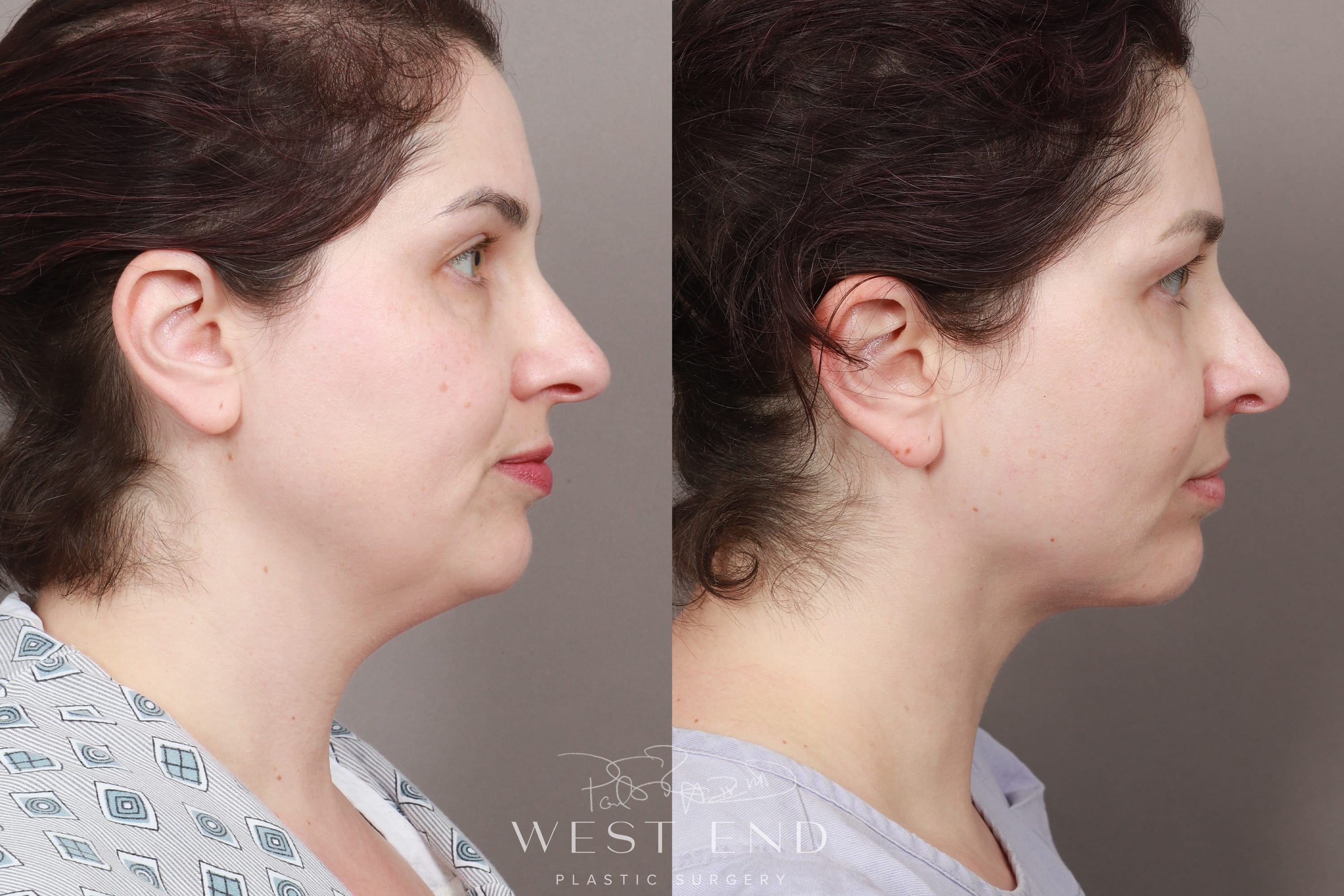 Liposuction & Renuvion Skin Tightening (1.5 Months Post-op)