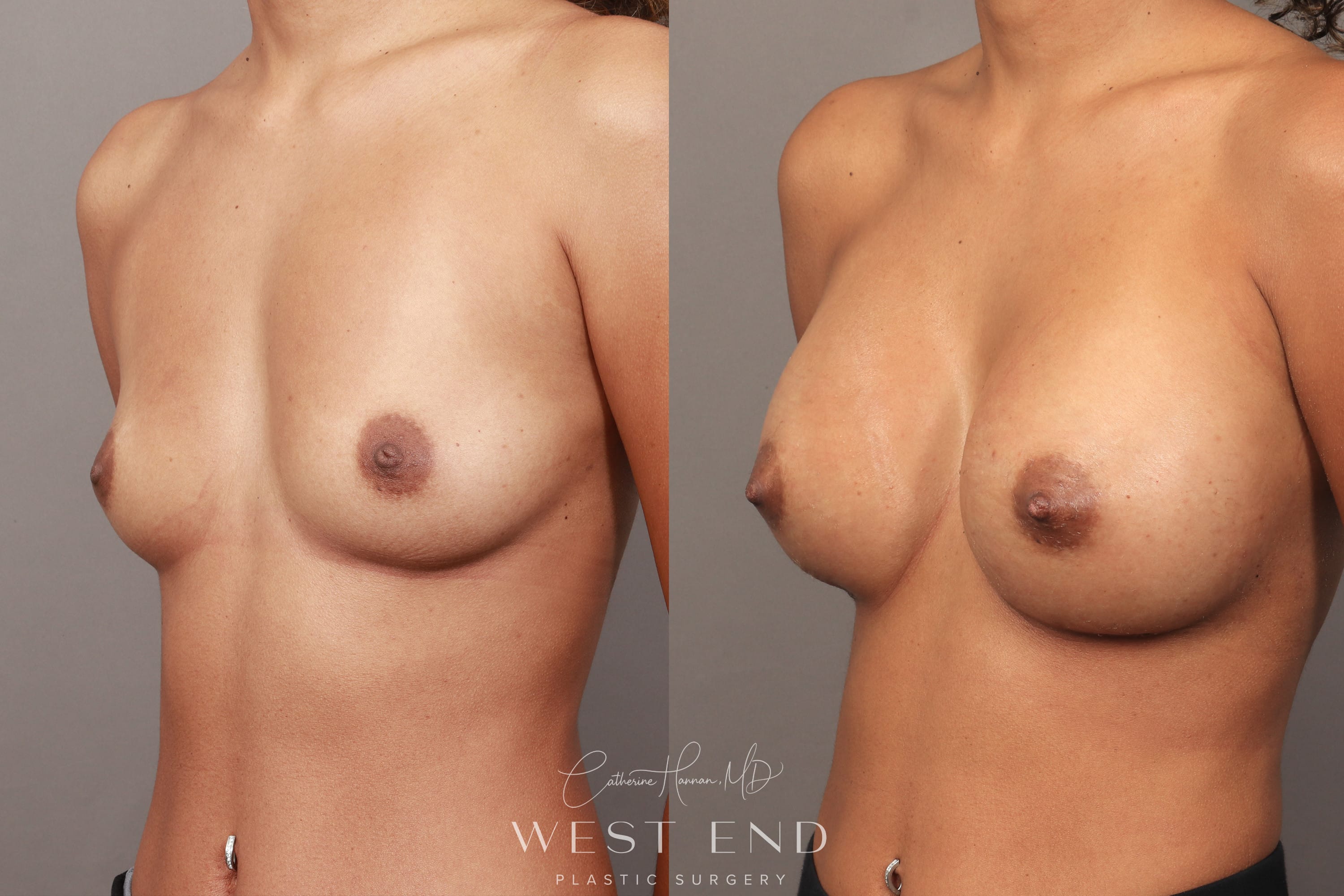 Breast Augmentation (3 Weeks Post-op)
