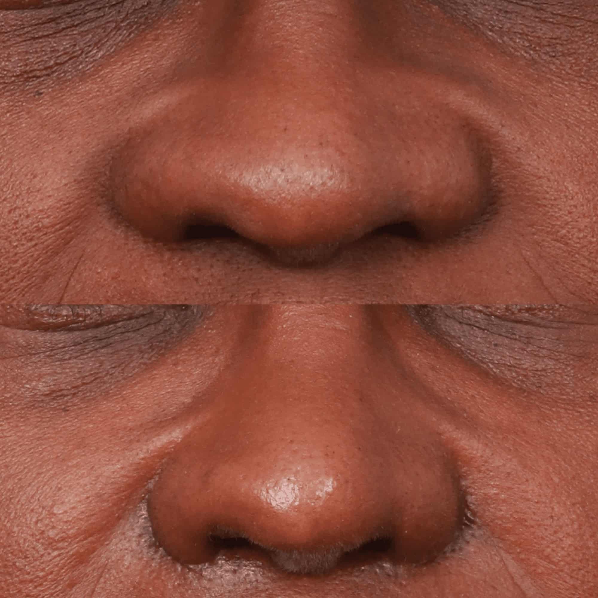 Nostril Reduction (Alarplasty) (1 Month Post-op)