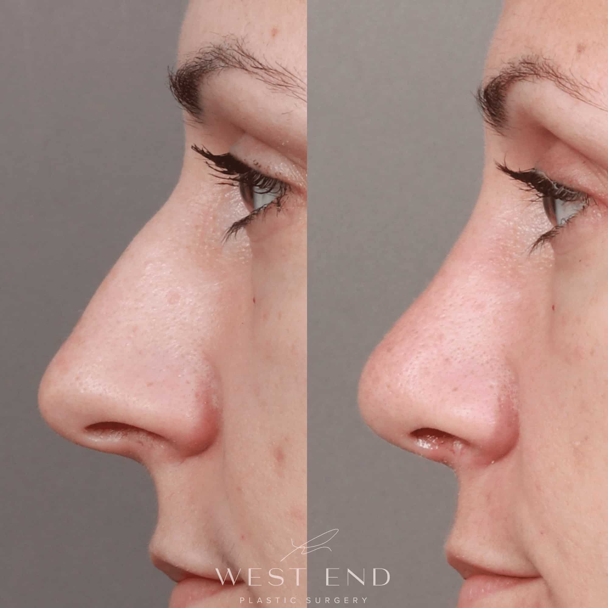 Rhinoplasty & Septoplasty (3.5 Months Post-op)