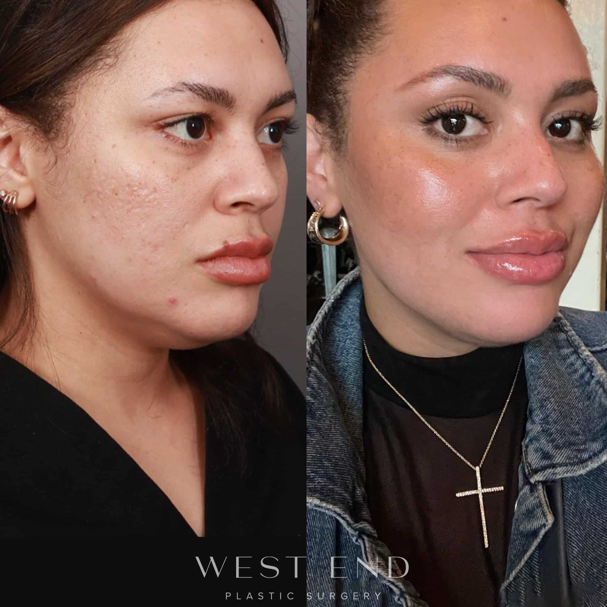 Restylane Contour