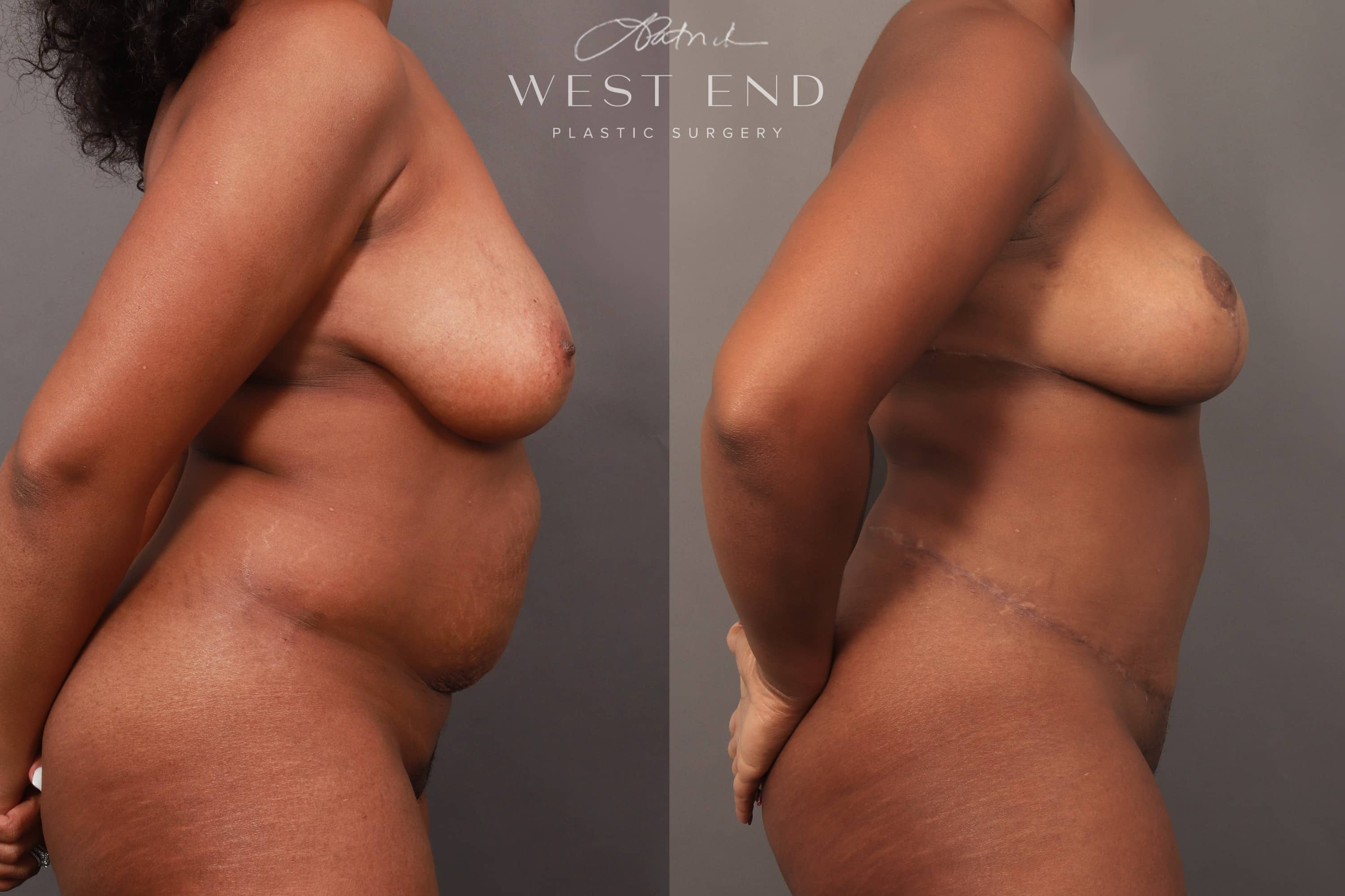 Mommy Makeover (Tummy Tuck & Breast Lift)