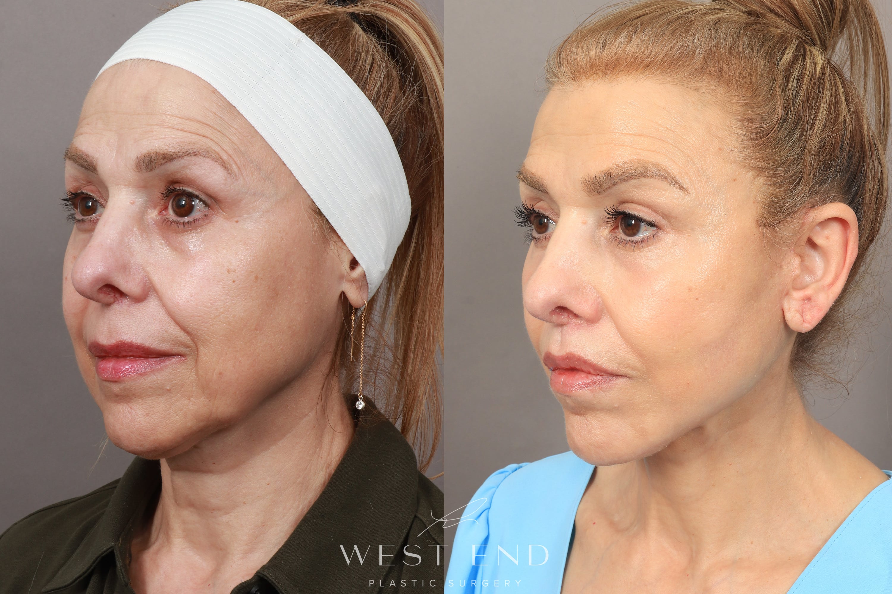 Deep Plane Facelift and Neck Lift, Brow Lift, Blepharoplasty (Eyelid Lift), Lip Lift, Fat Grafting, and CO2 Resurfacing.