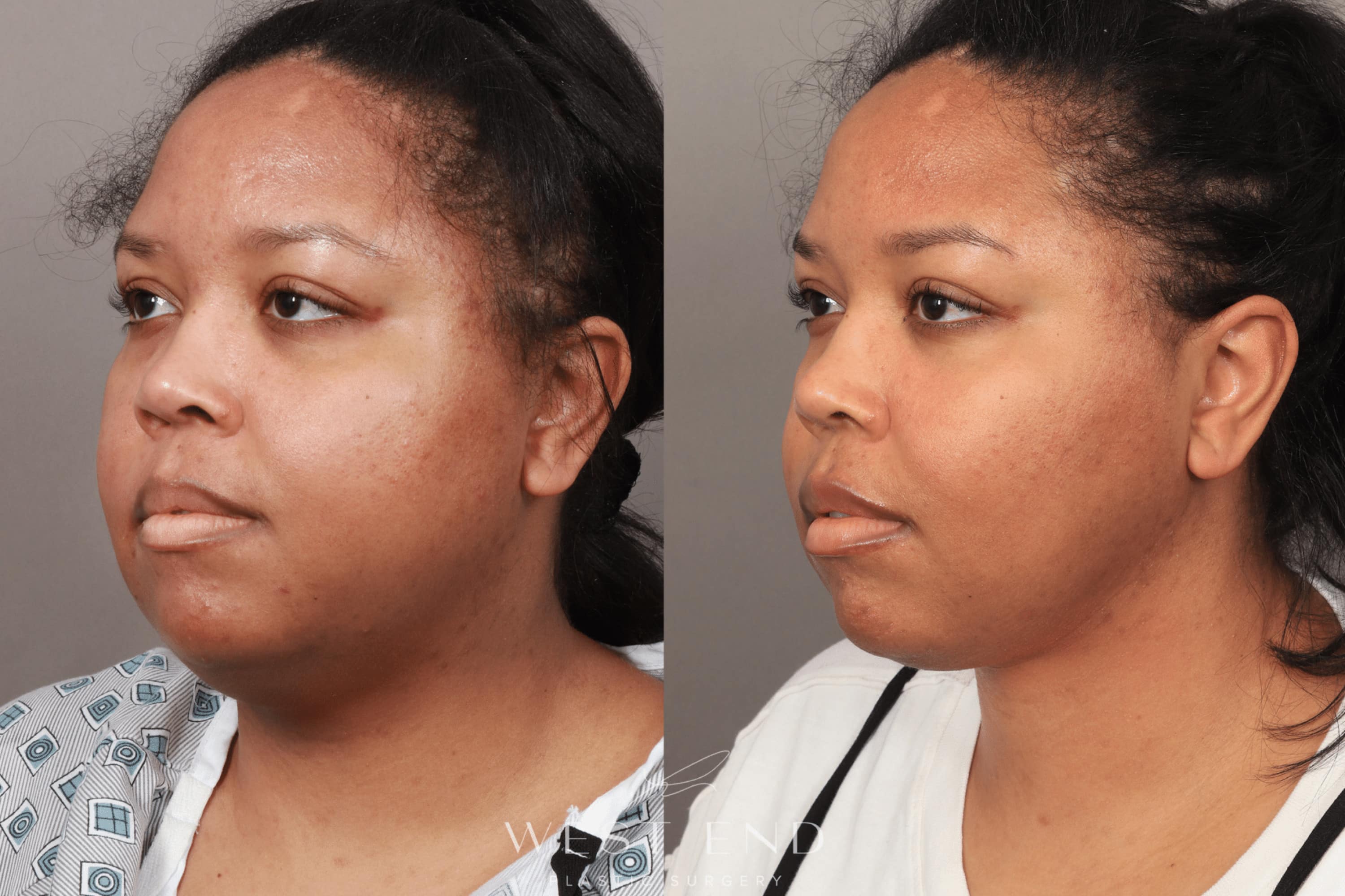 Buccal Fat Removal, Liposuction, and Renuvion Skin Tightening (1 Month Post-op)