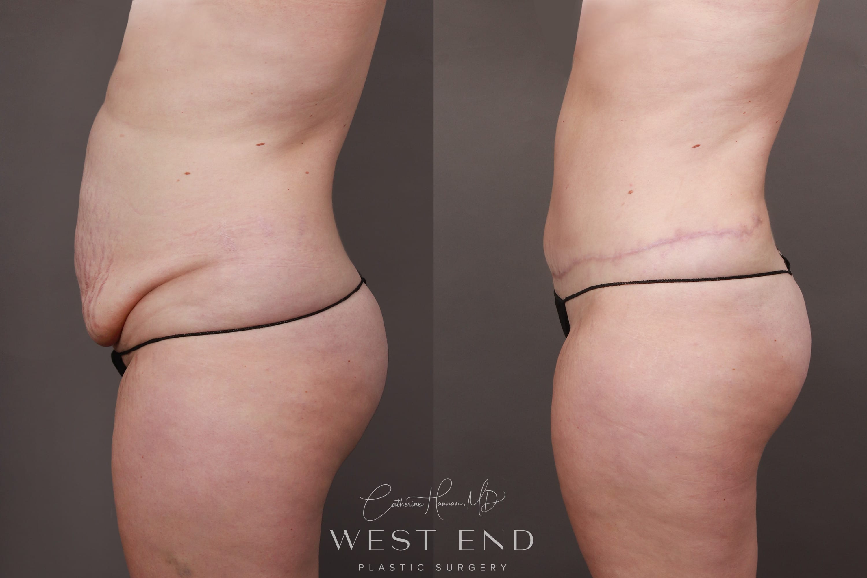 Tummy Tuck (6 Months Post-op)