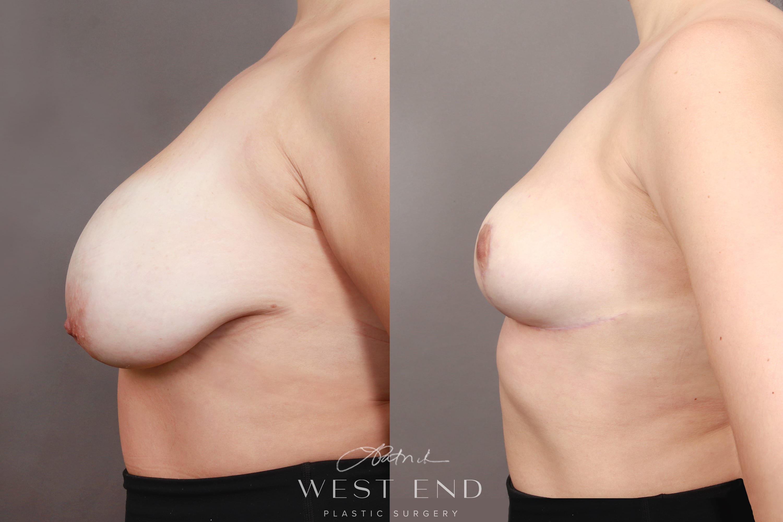 Breast Reduction (2 Months Post-op)