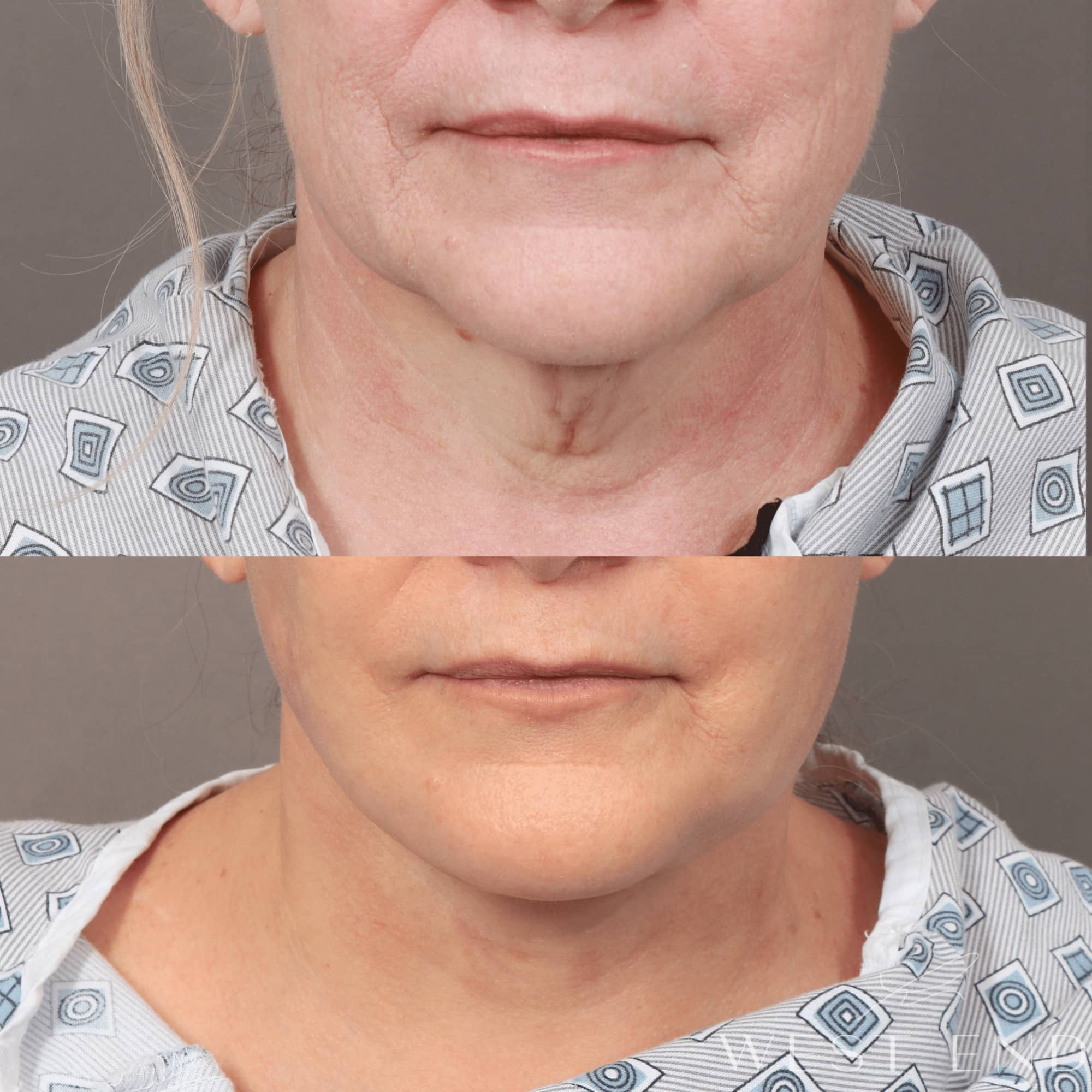 Deep Plane Facelift & Neck Lift, Fat Grafting, and CO2 Resurfacing (2 Months Post-op)