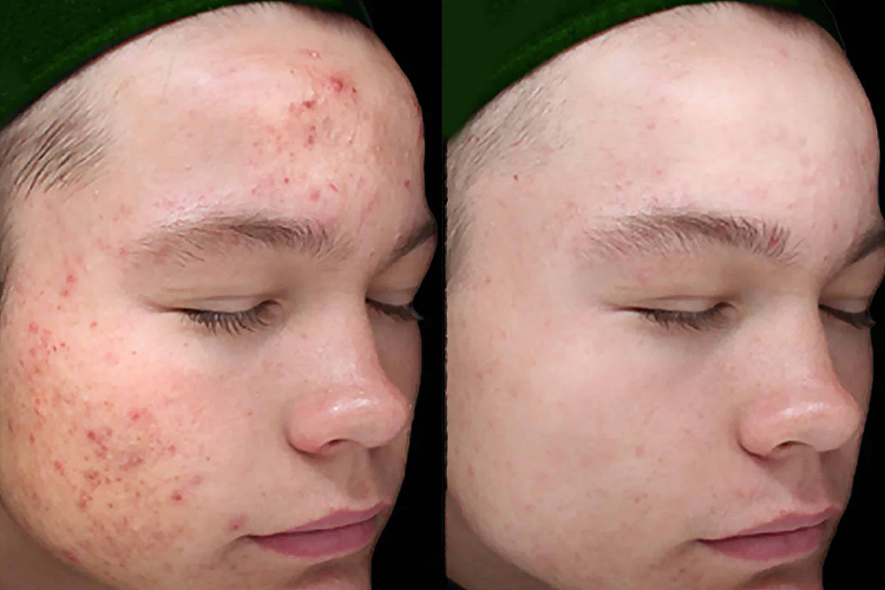 Chemical Peel (VI Peel)