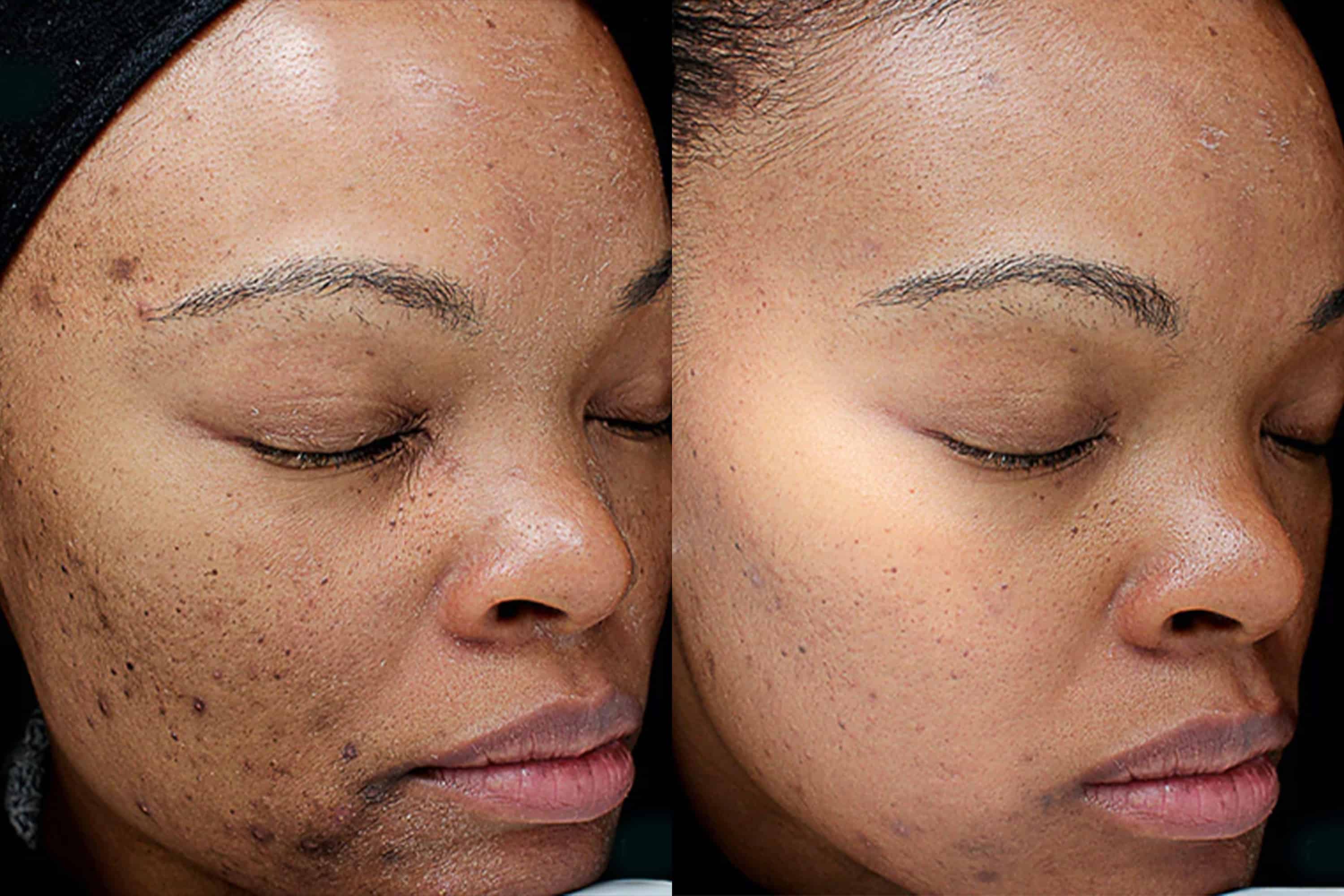 Chemical Peel (VI Peel)