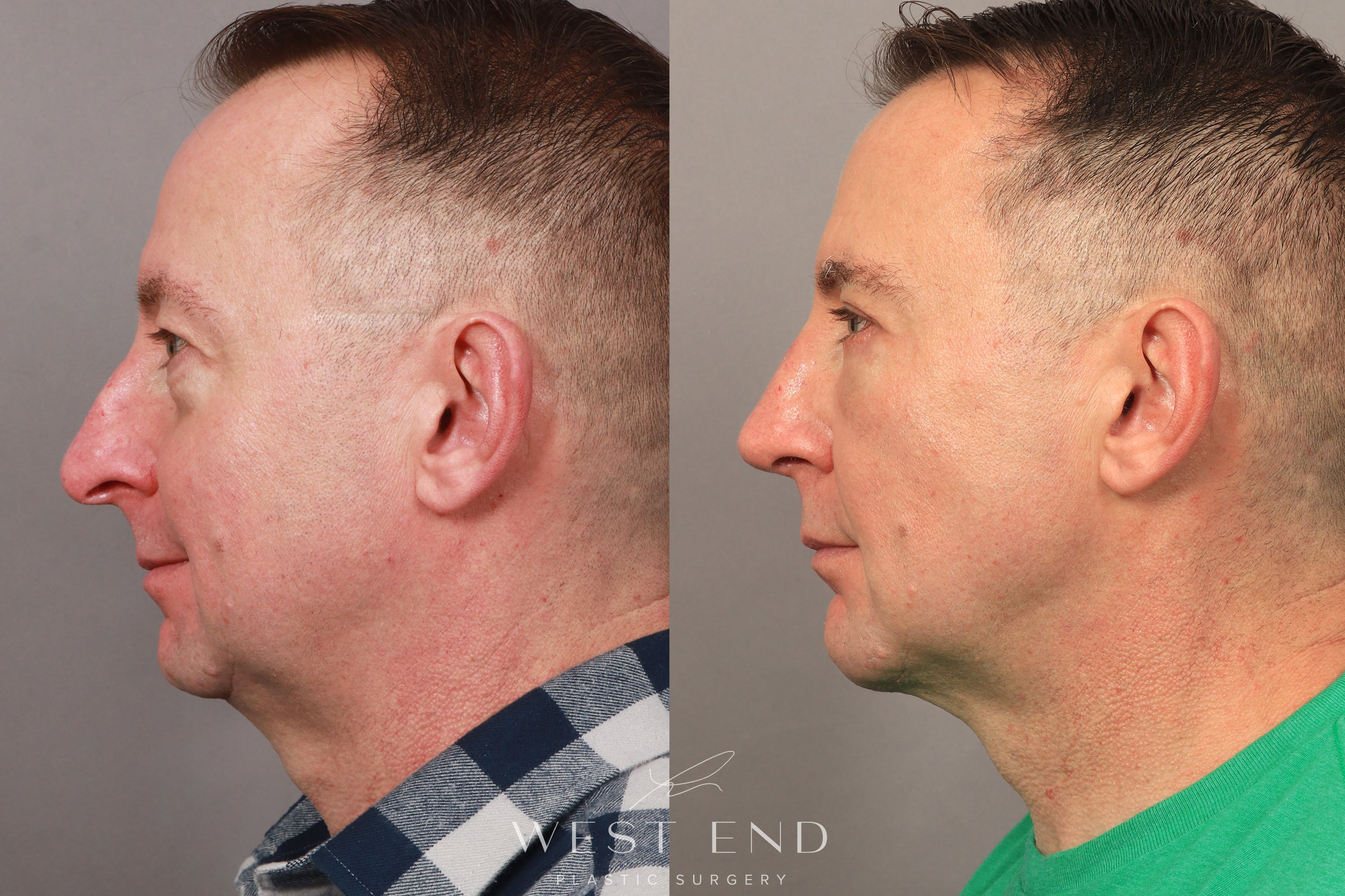 Blepharoplasty, Chin Implant, Rhinoplasty, Brow Lift, Fat Grafting, and CO2 Resurfacing (9 Months Post-op)