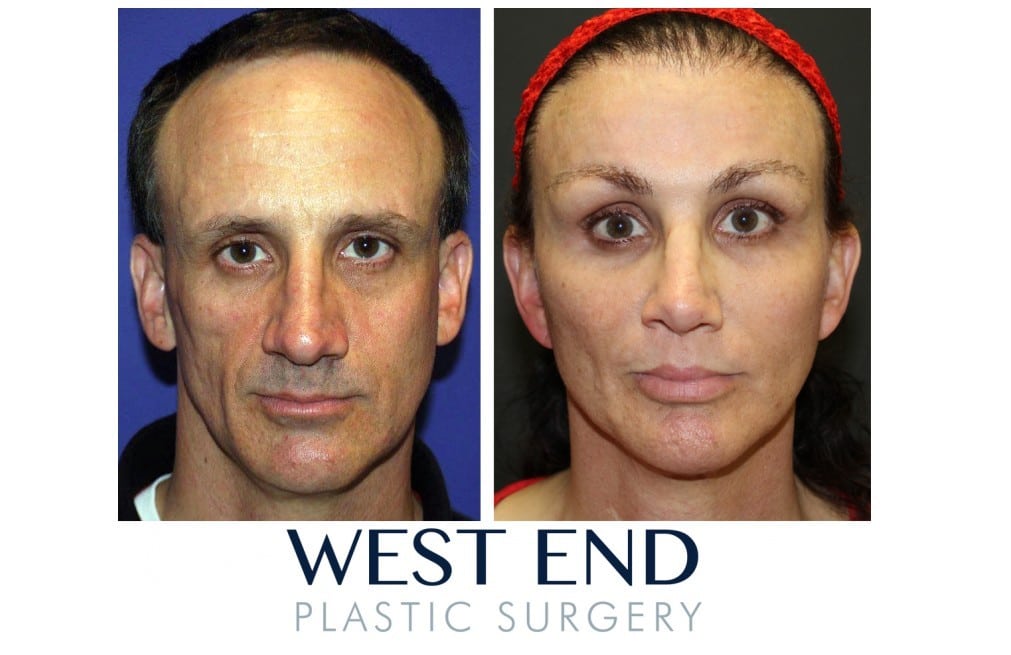 tracheal shave before and after gallery west end plastic surgery