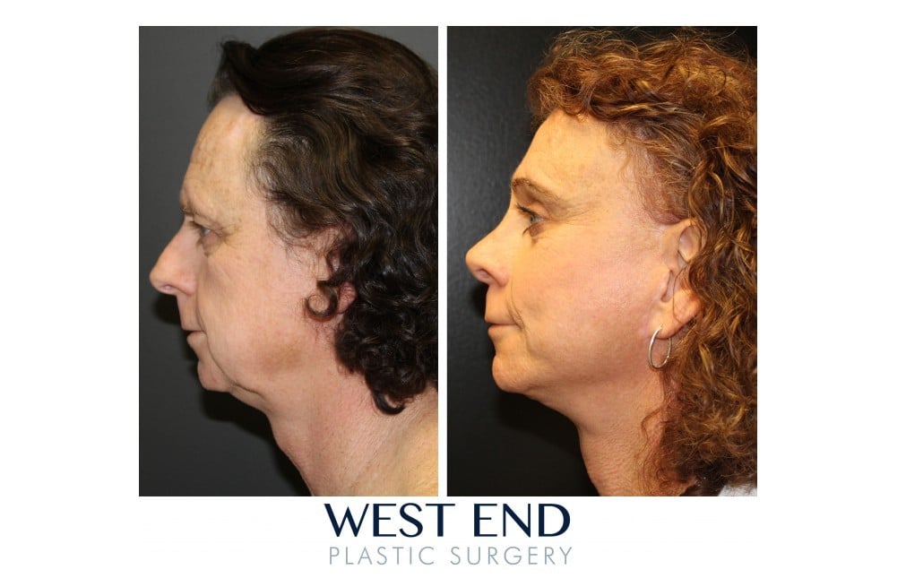 facial feminisation tracheal shave plastic surgeons Facial feminisation tracheal shave plastic surgeons
