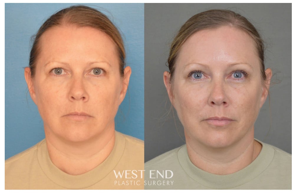 Blepharoplasty & Endoscopic Brow Lift before photo. Individual results may vary.