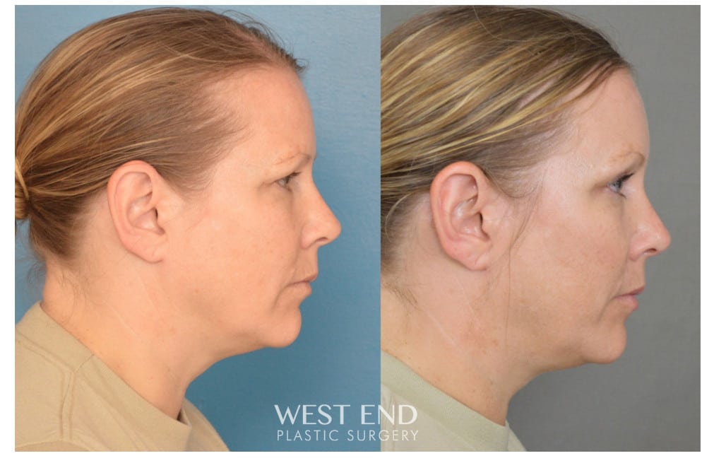 Blepharoplasty & Endoscopic Brow Lift before photo. Individual results may vary.