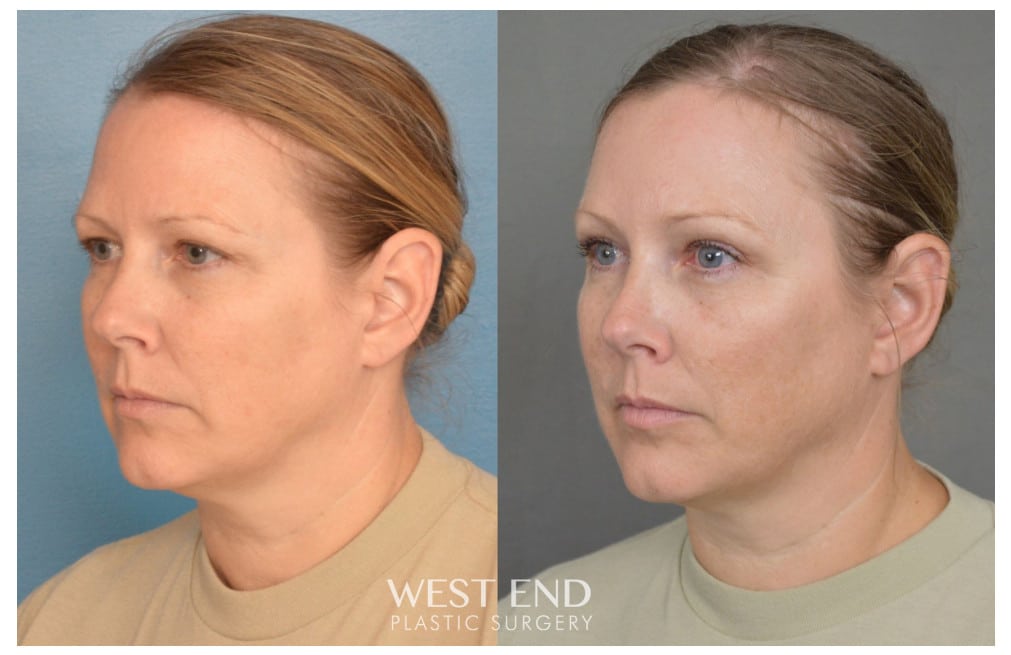 Blepharoplasty & Endoscopic Brow Lift before photo. Individual results may vary.