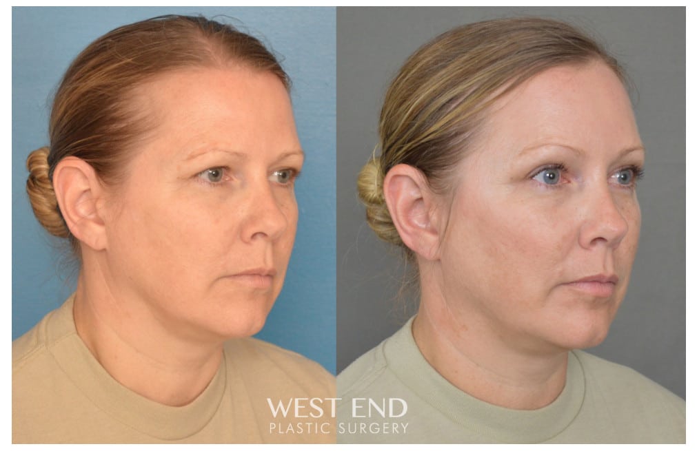 Blepharoplasty & Endoscopic Brow Lift before photo. Individual results may vary.