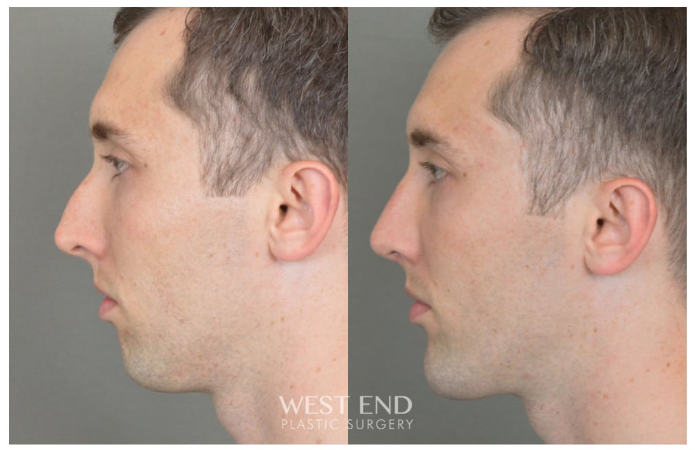 Chin Implant before photo. Individual results may vary.