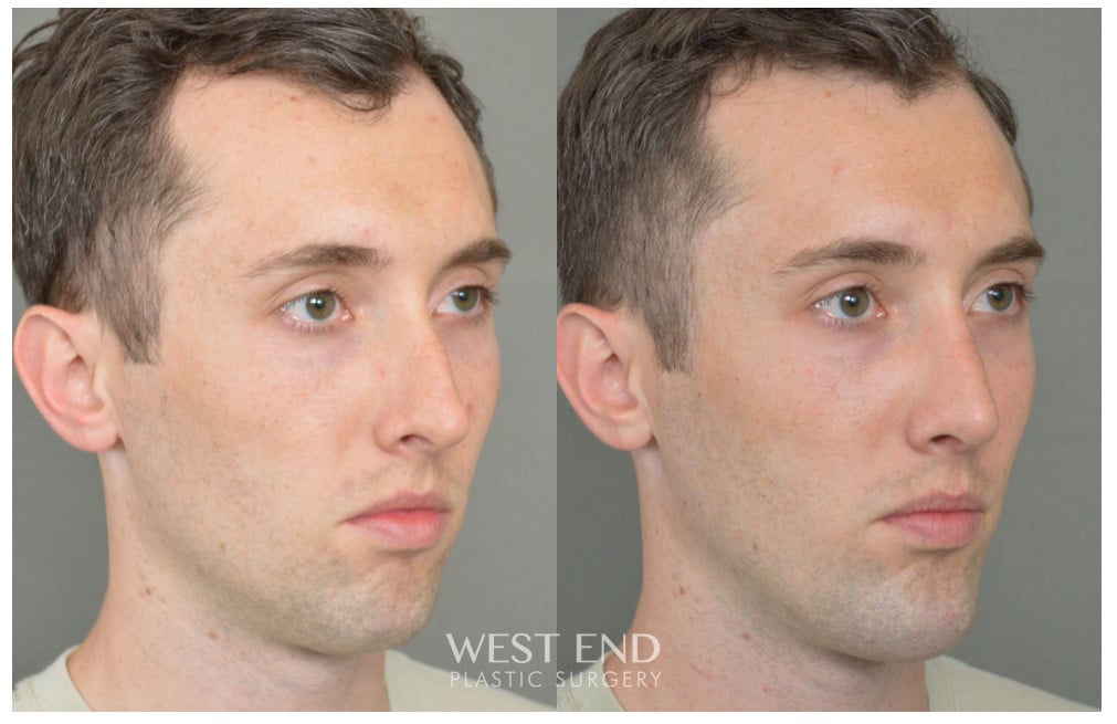 Chin Implant before photo. Individual results may vary.