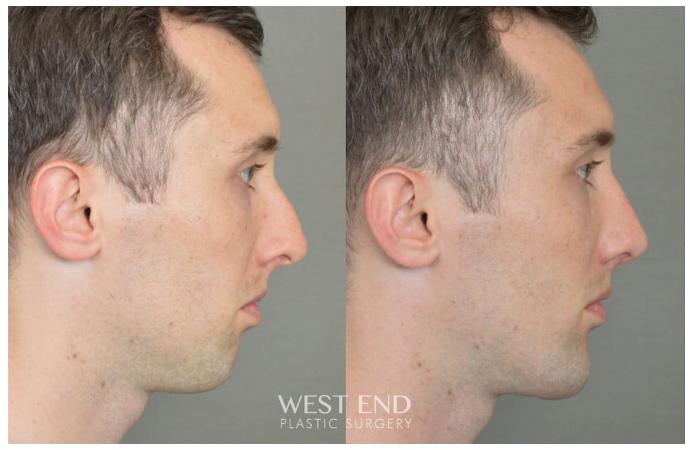 Chin Implant before photo. Individual results may vary.