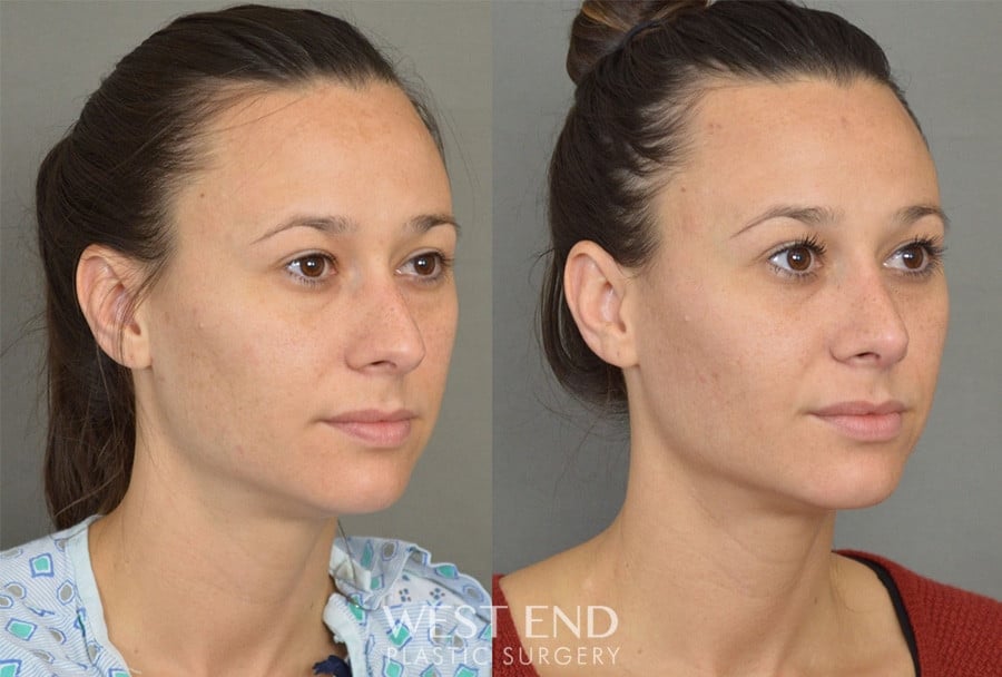 Rhinoplasty before photo. Individual results may vary.